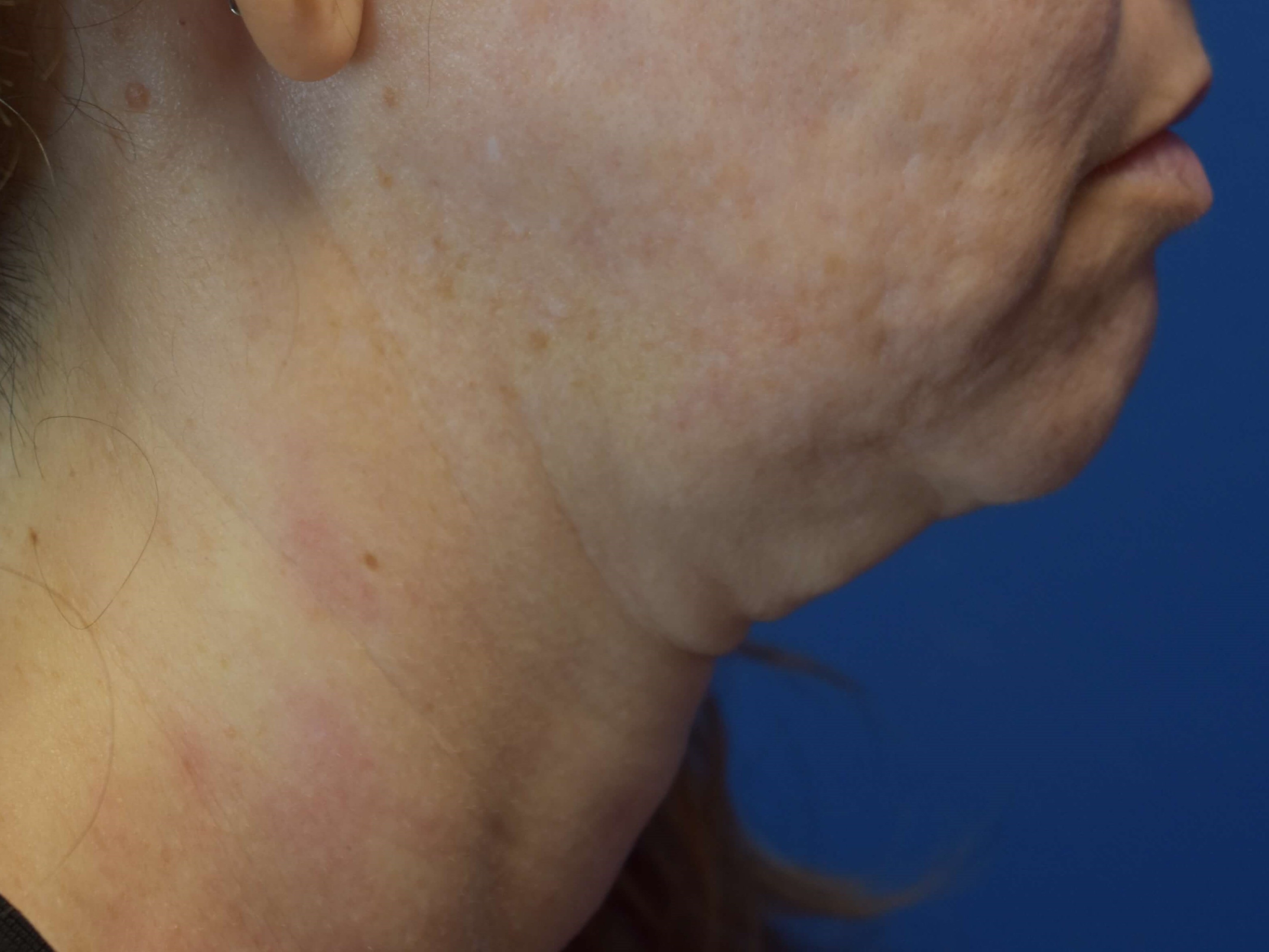 Neck Sofwave Before