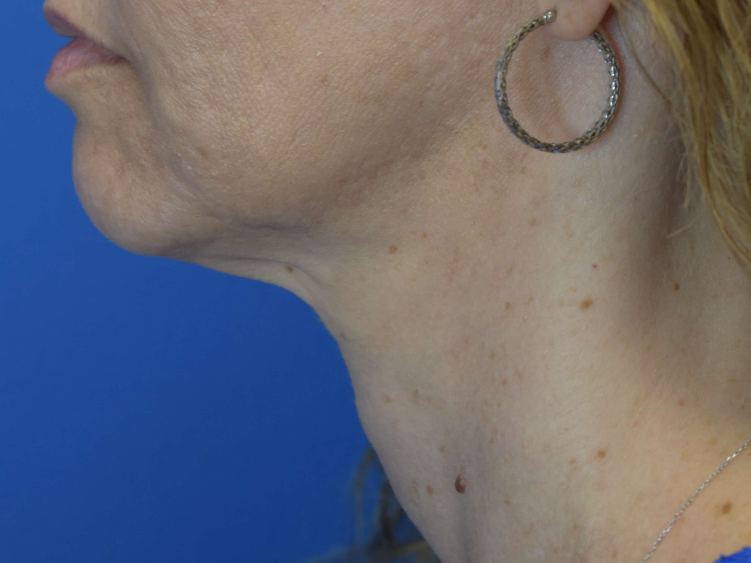 Neck Sofwave After