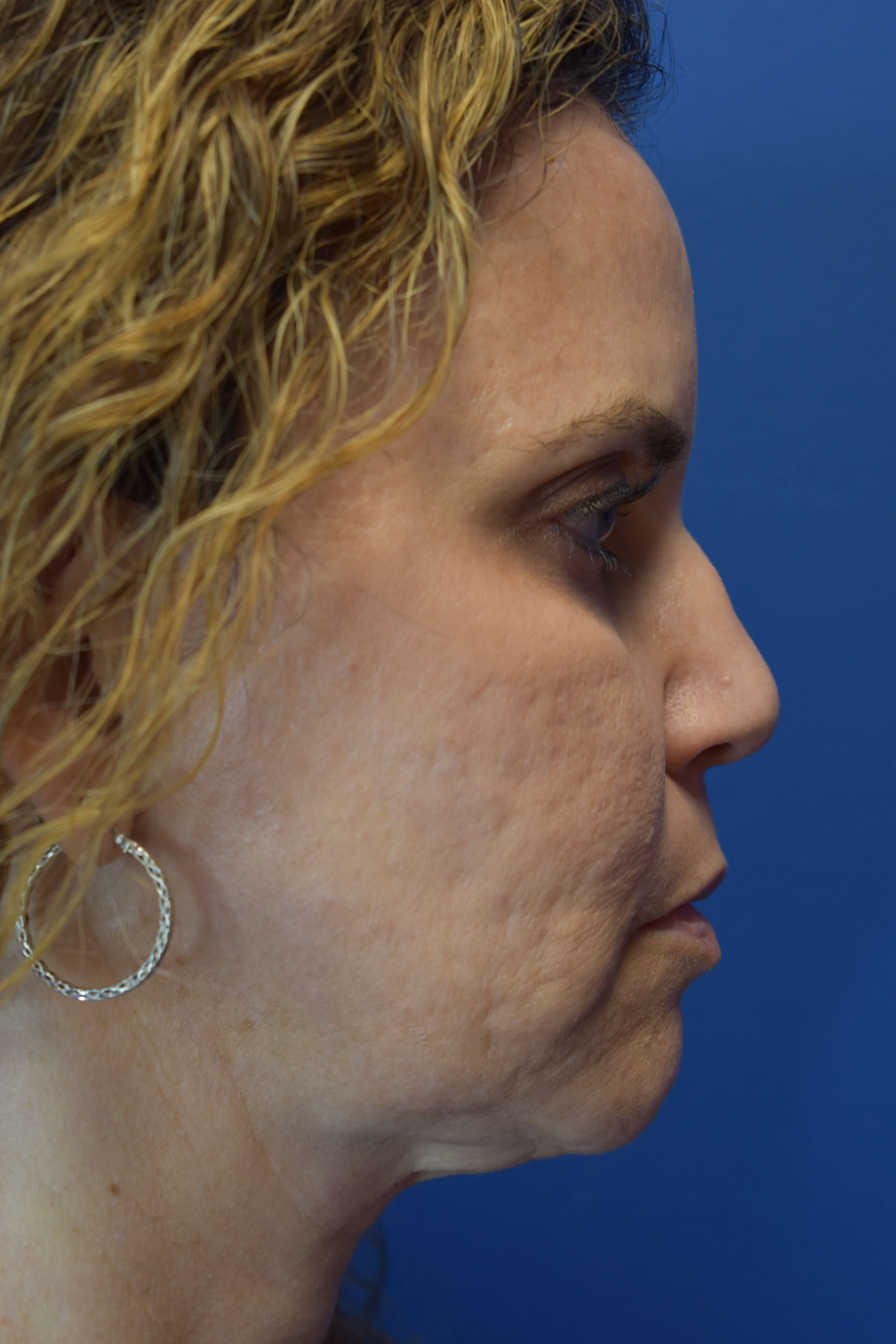 Neck Sofwave After