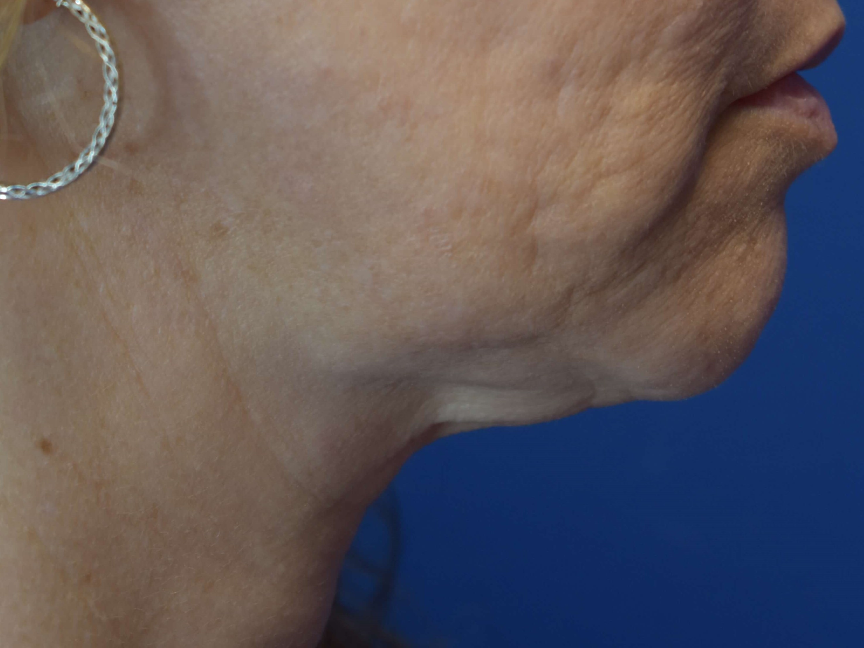 Neck Sofwave After