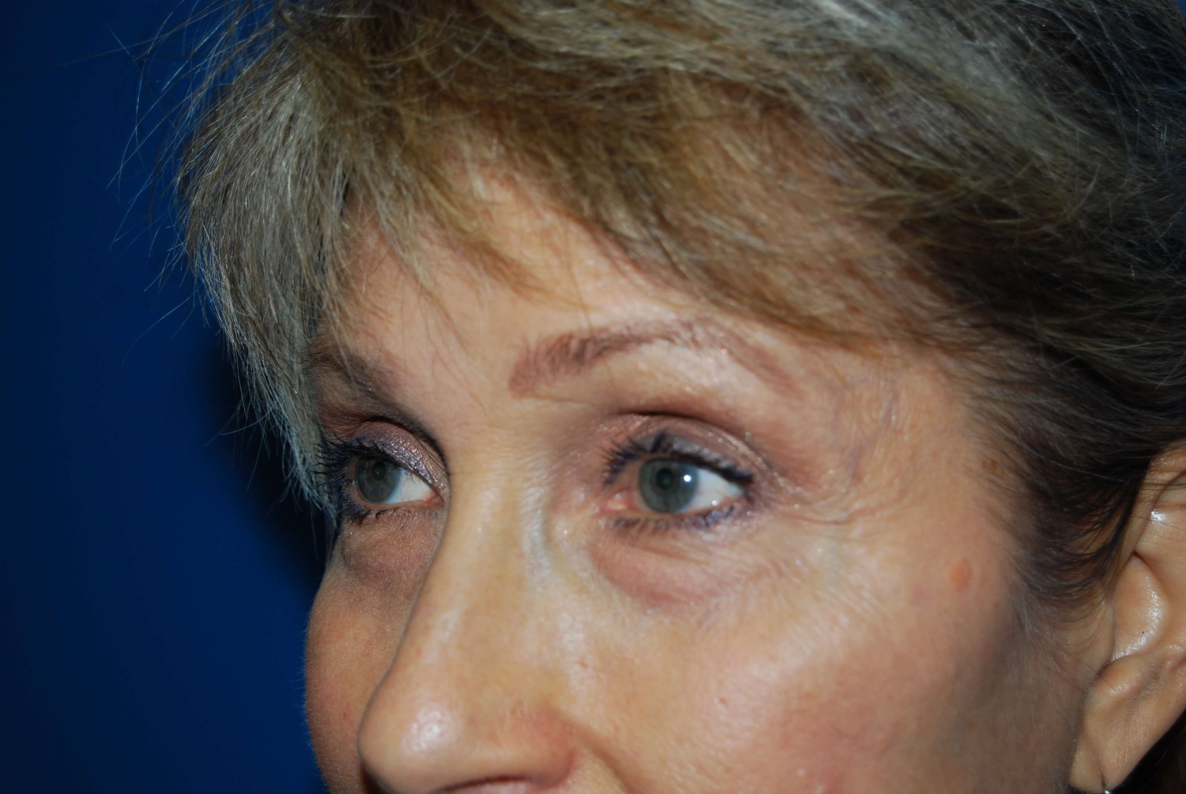 Neck and Brow Lift Before