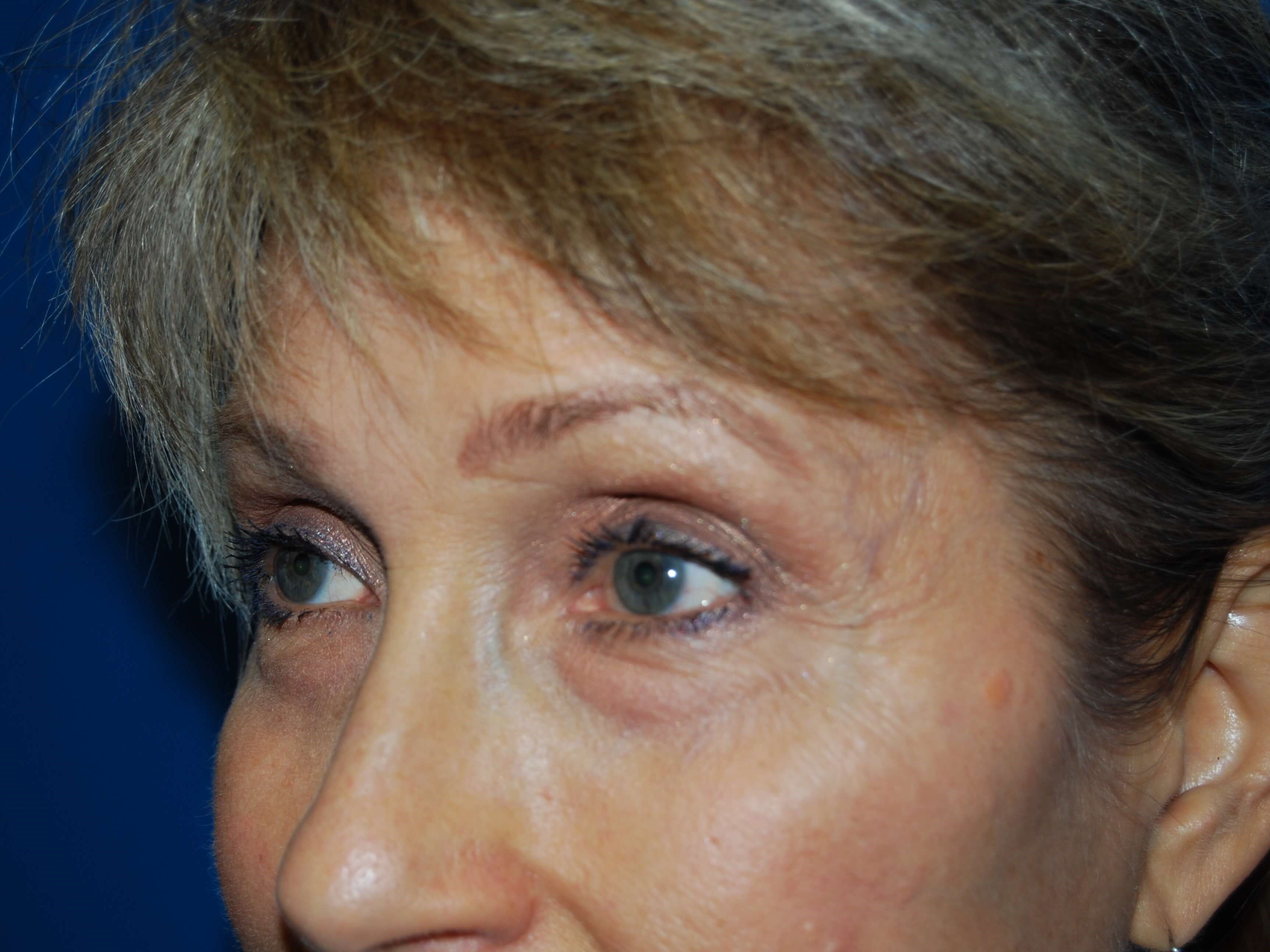 Neck and Brow Lift Before
