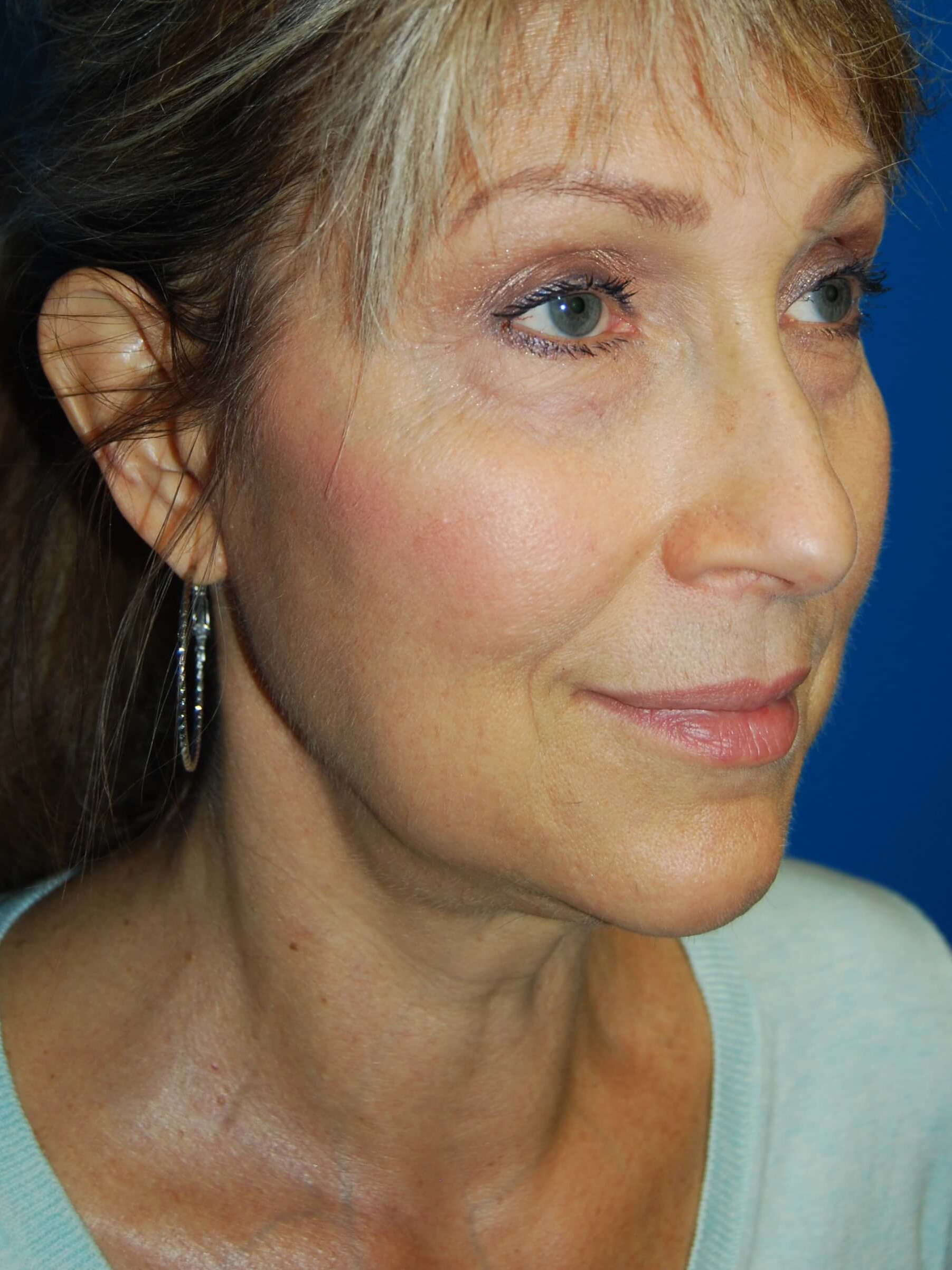 Neck and Brow Lift Before