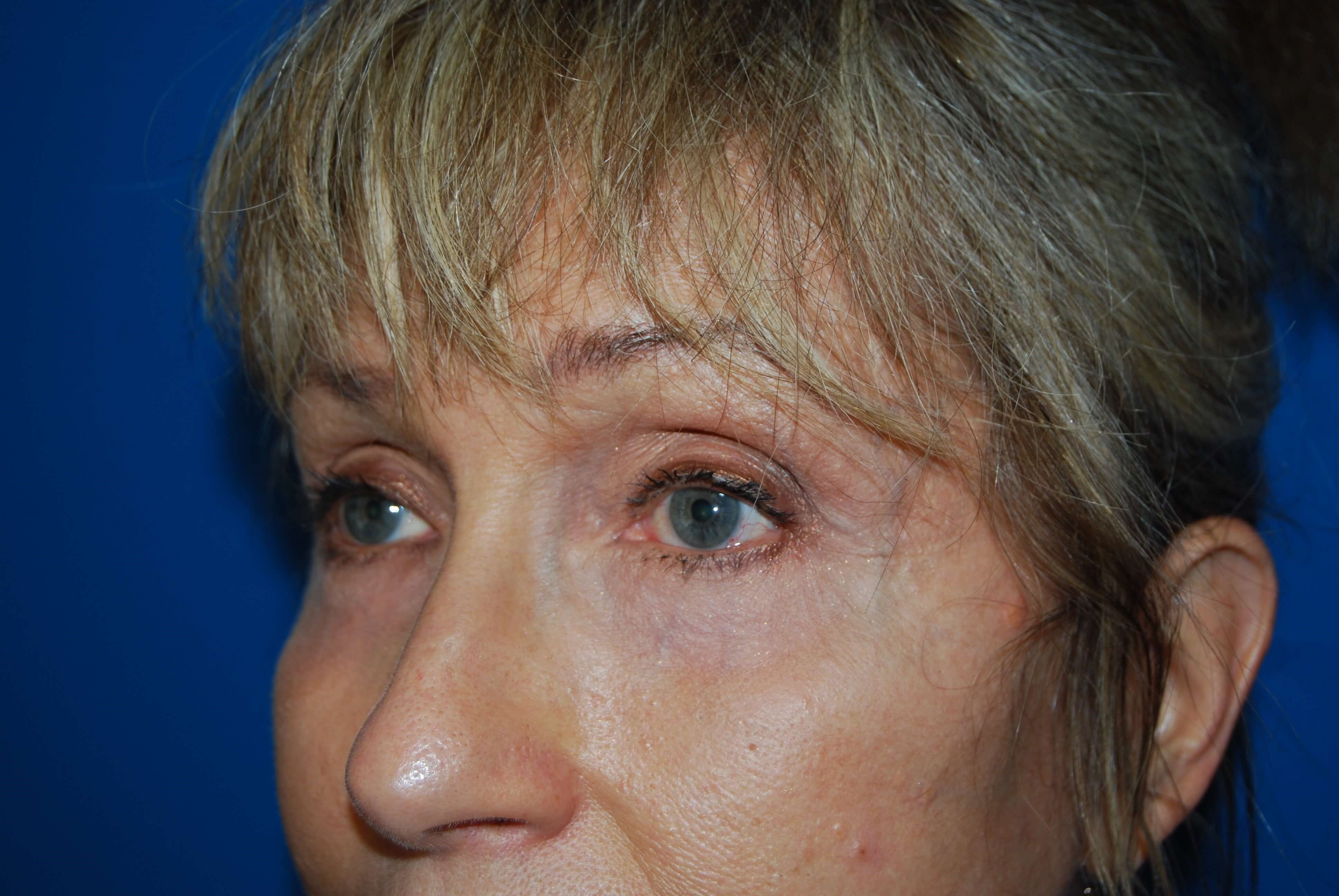 Neck and Brow Lift After