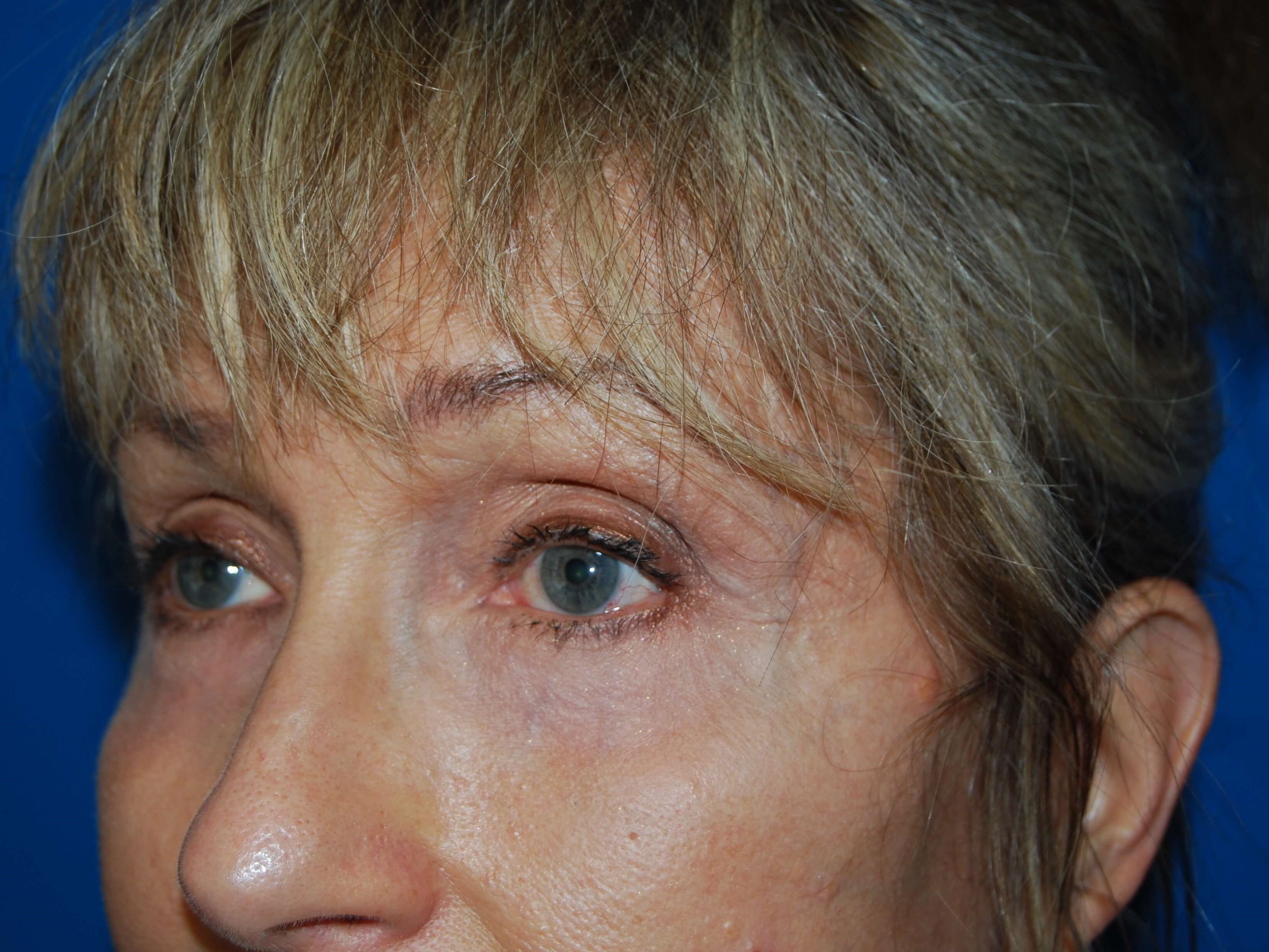 Neck and Brow Lift After