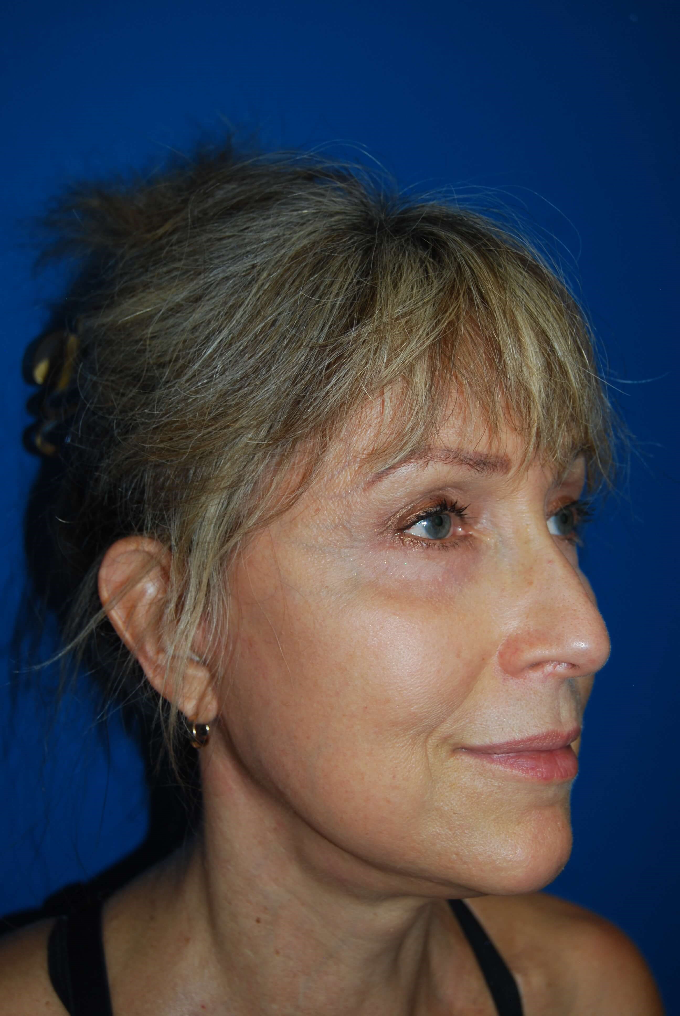 After Image