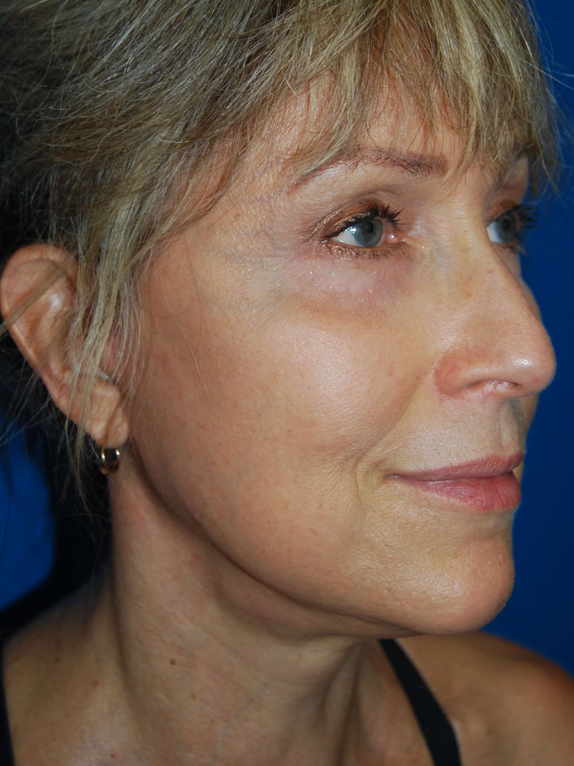 Neck and Brow Lift After