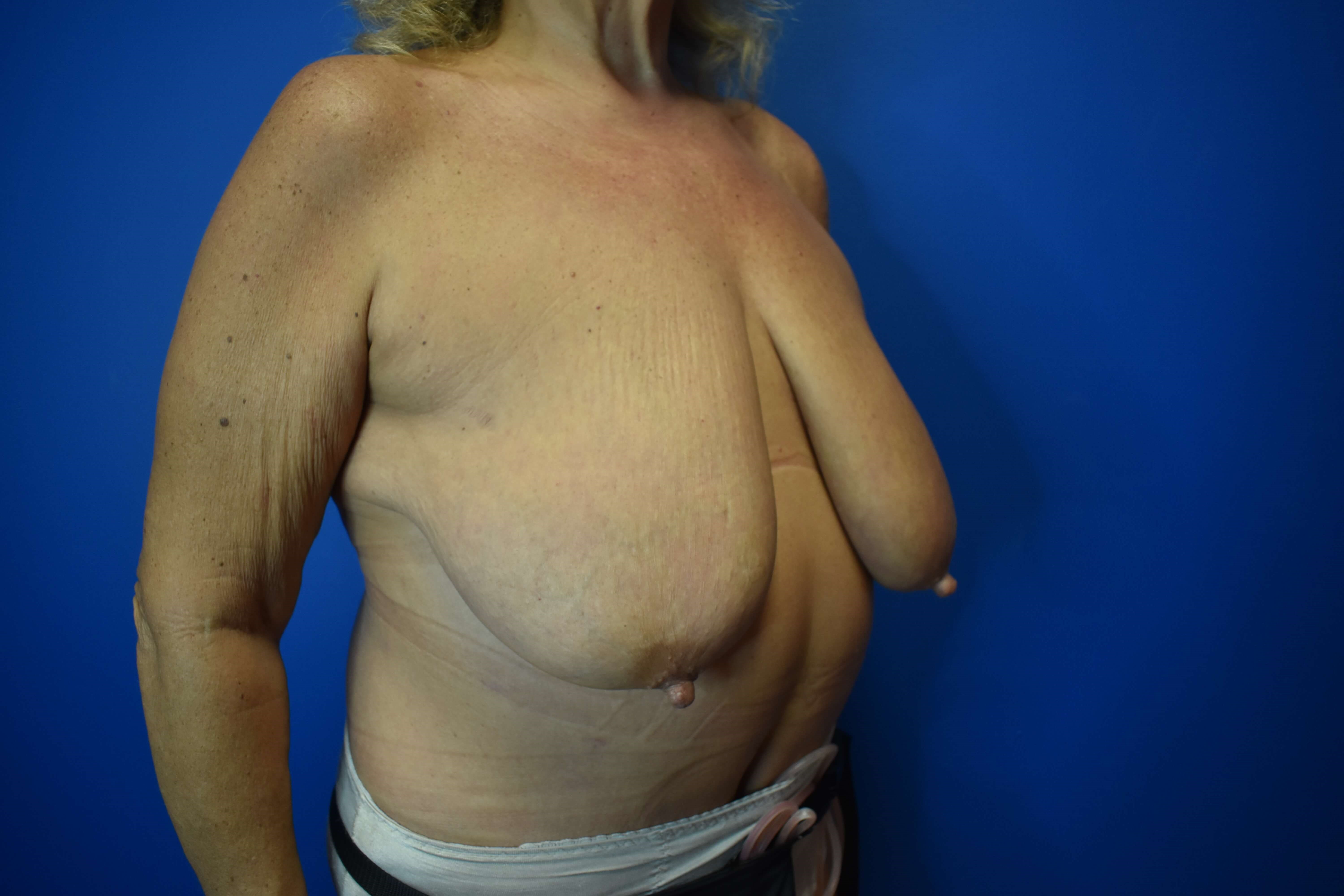 Breast Reduction Before