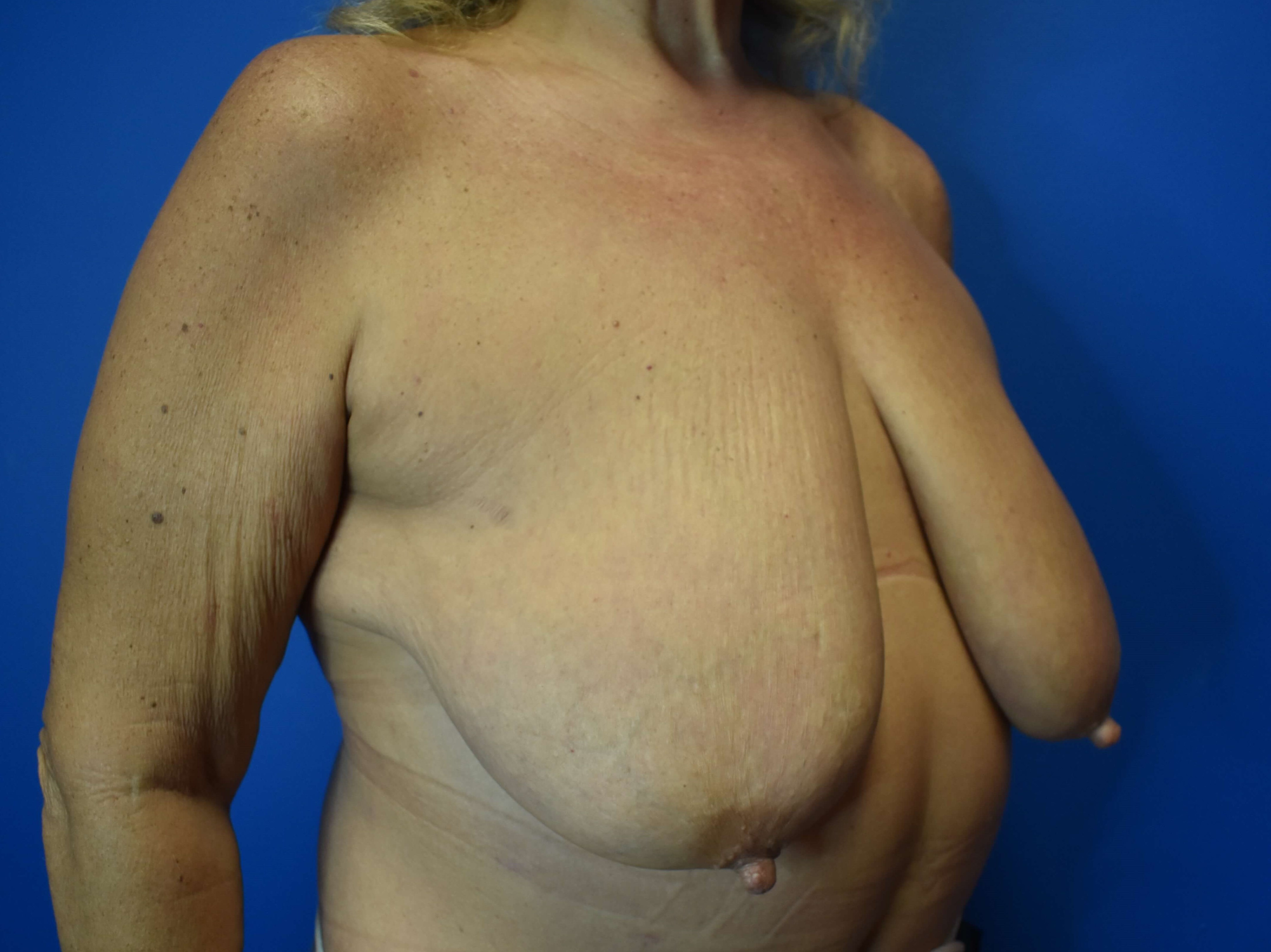 Breast Reduction Before