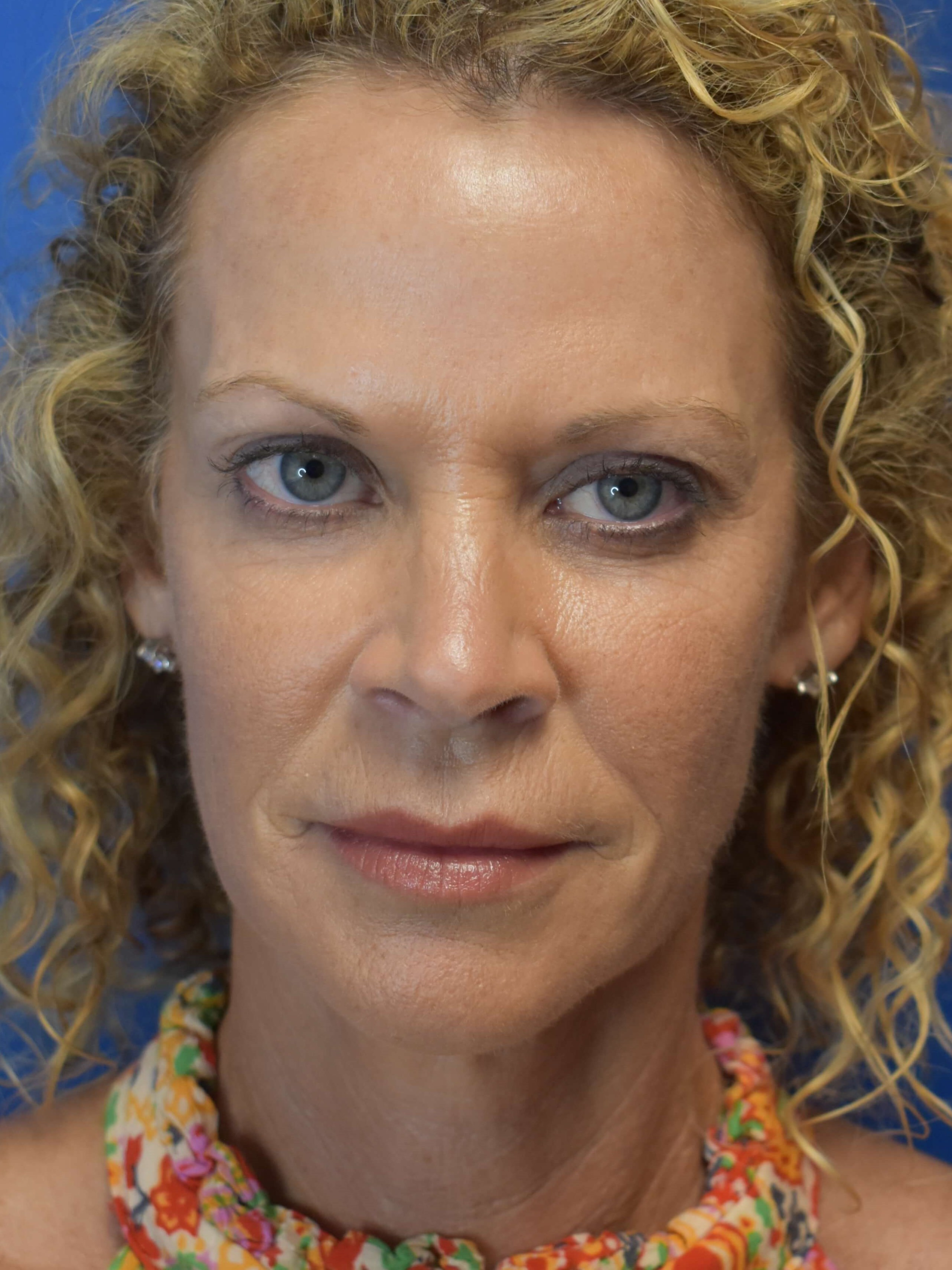 Facelift + Lower Lids Before