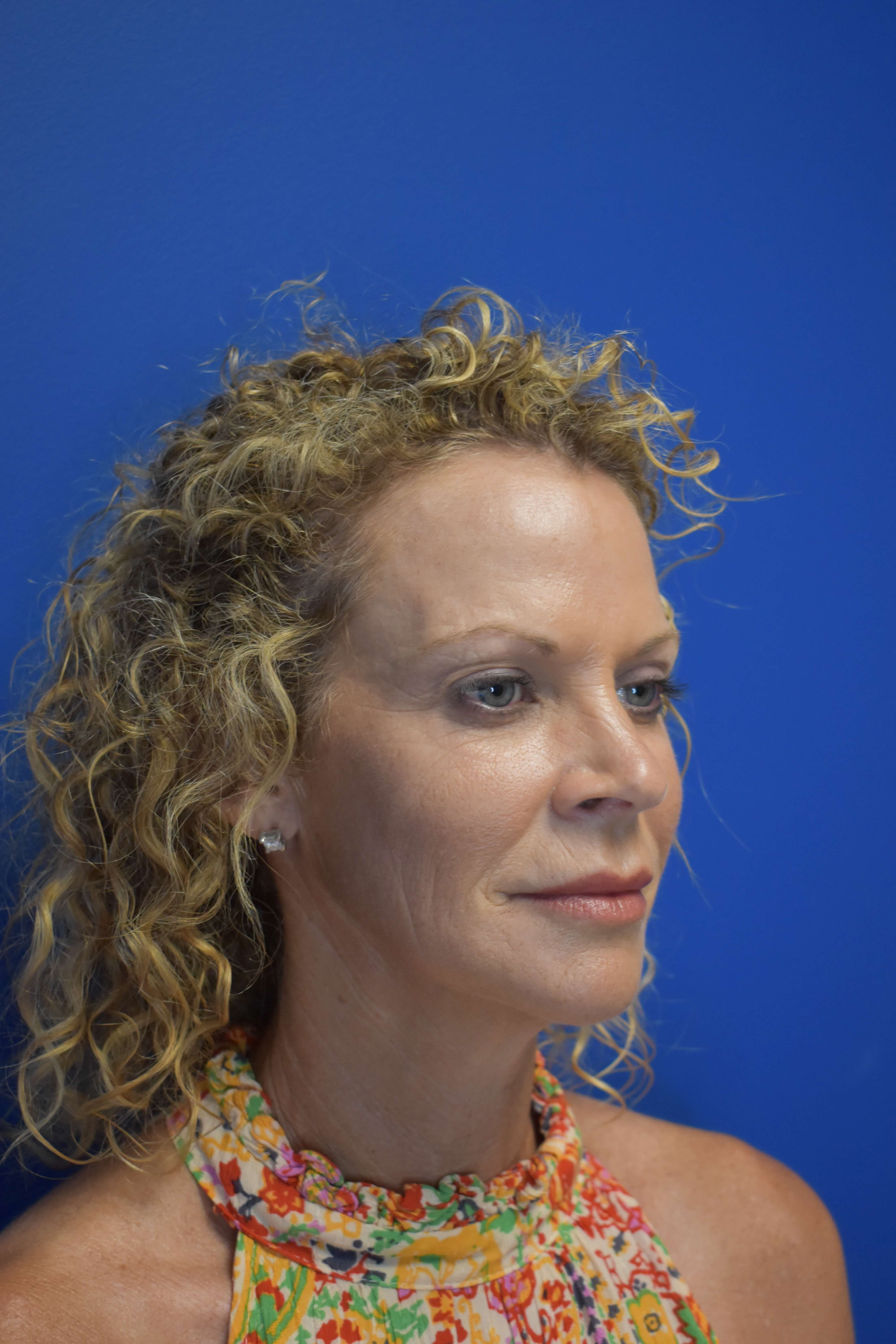 Facelift + Lower Lids Before