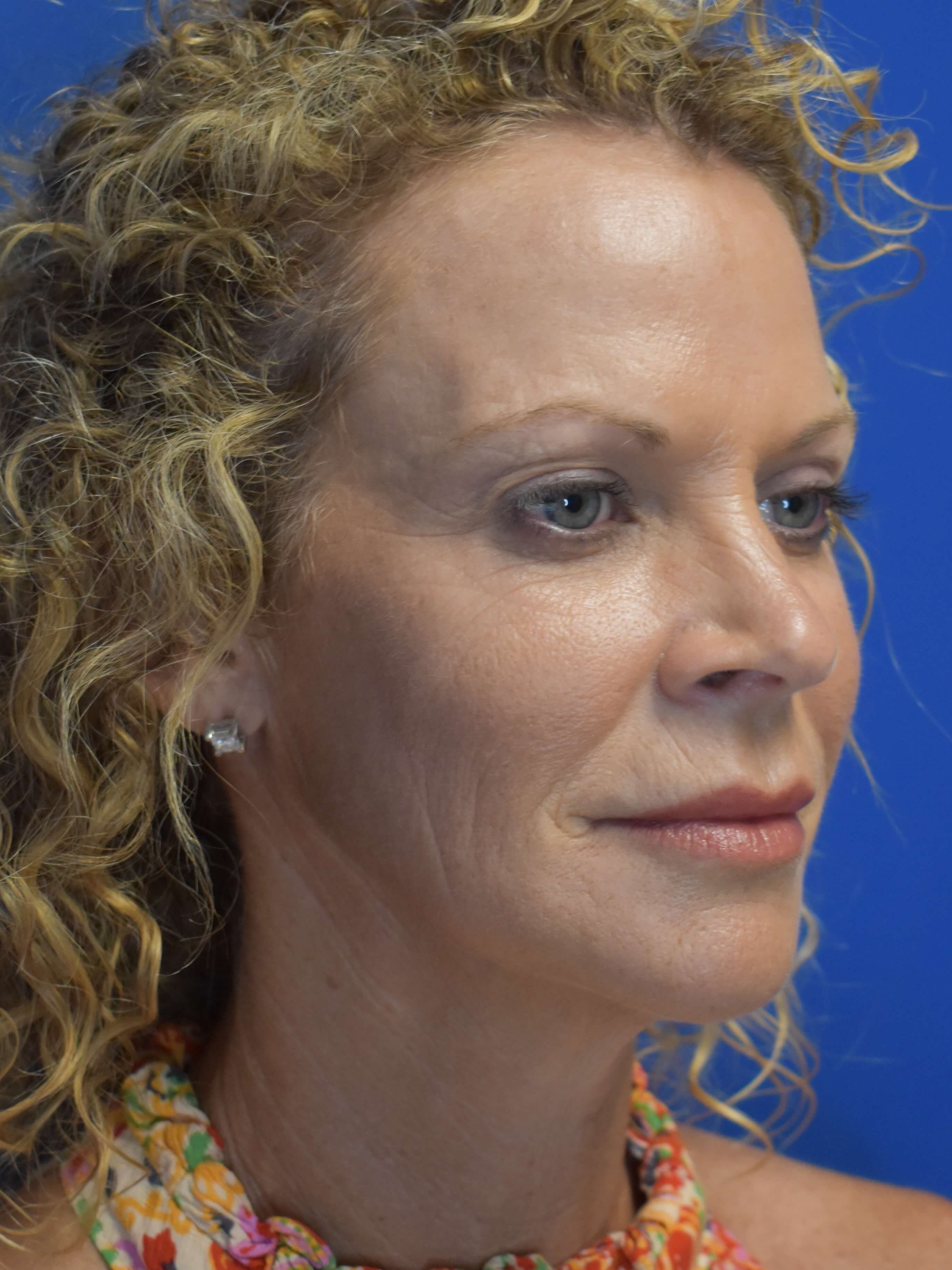Facelift + Lower Lids Before