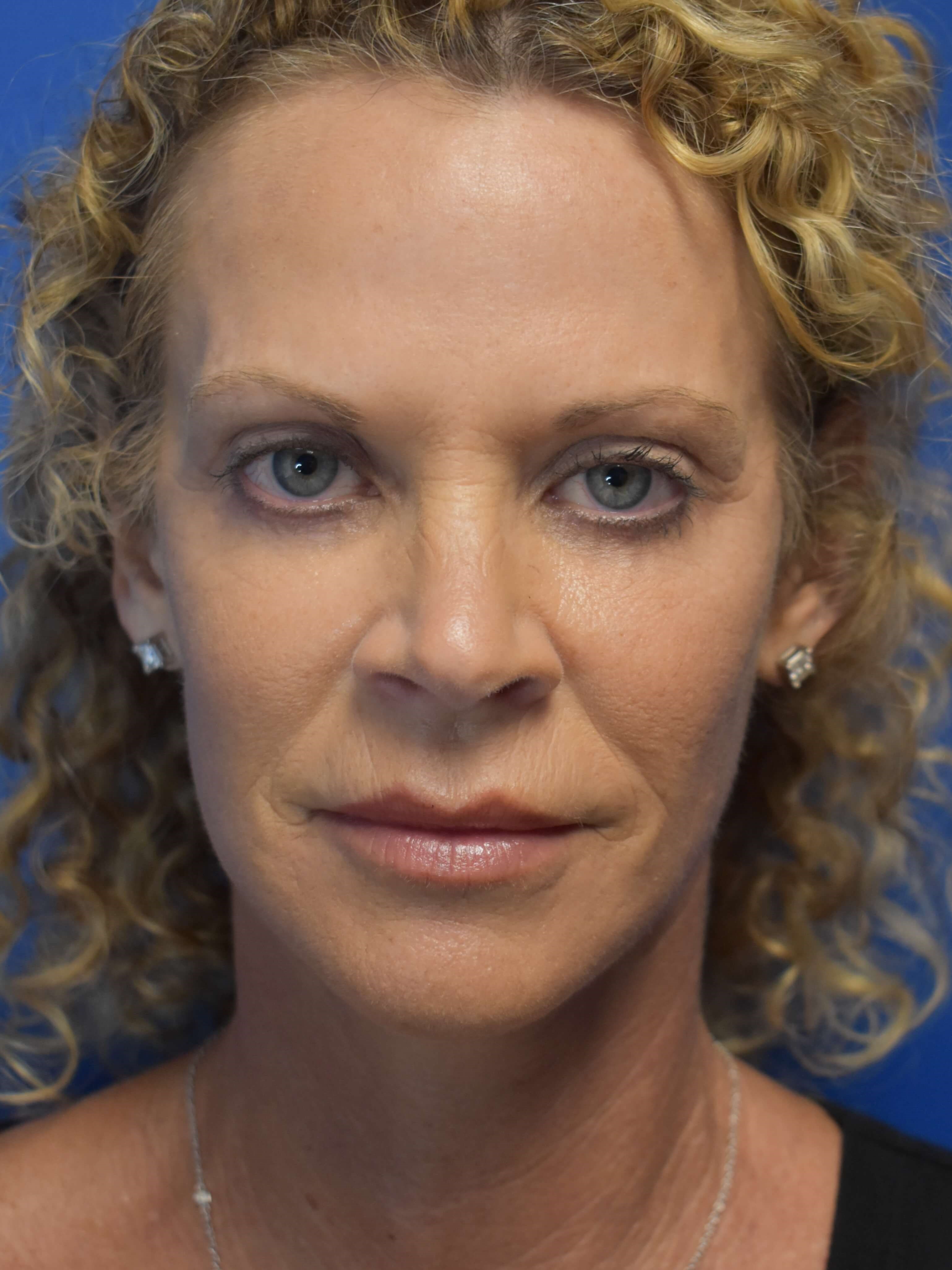 Facelift + Lower Lids After