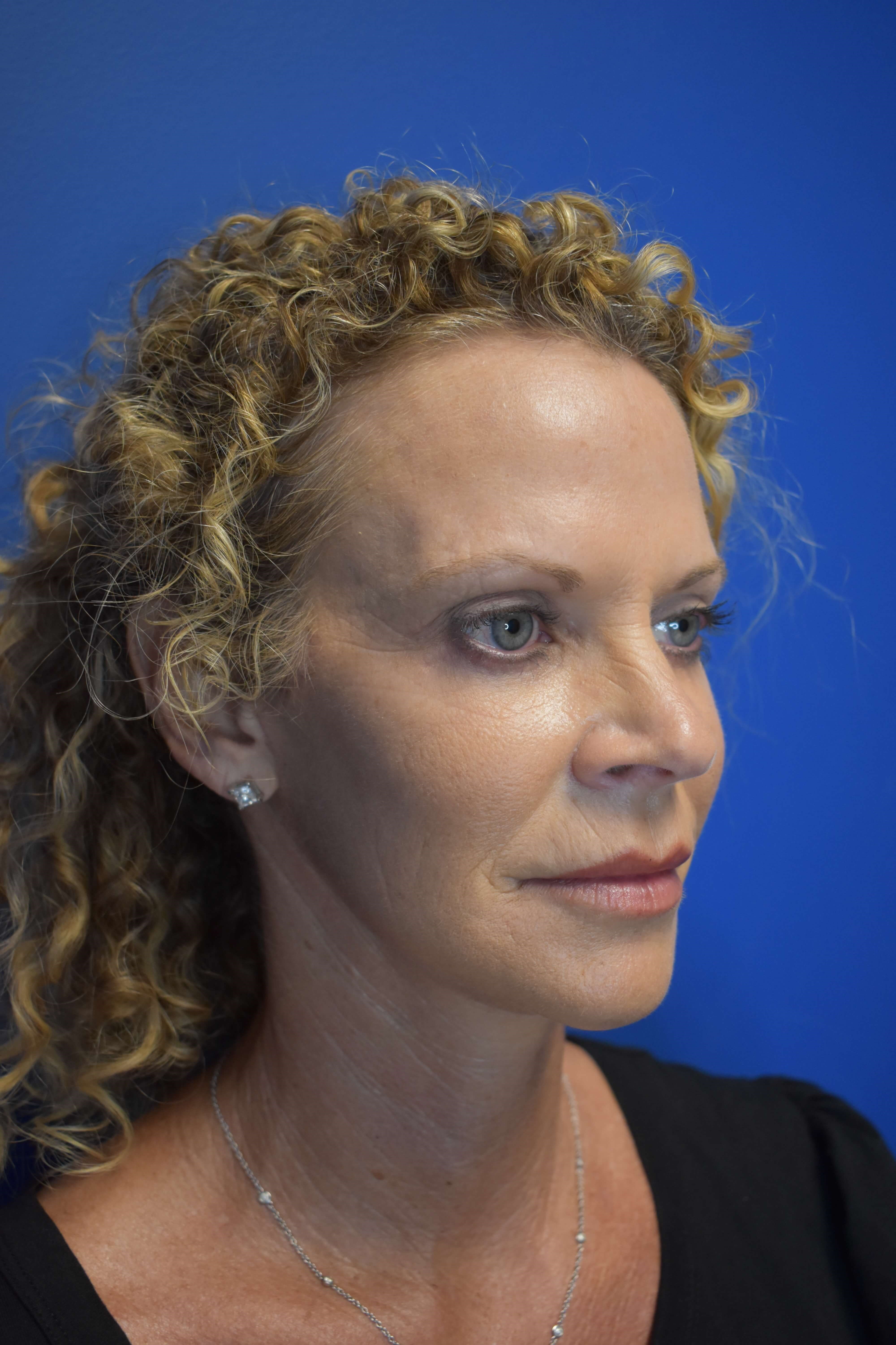 Facelift + Lower Lids After