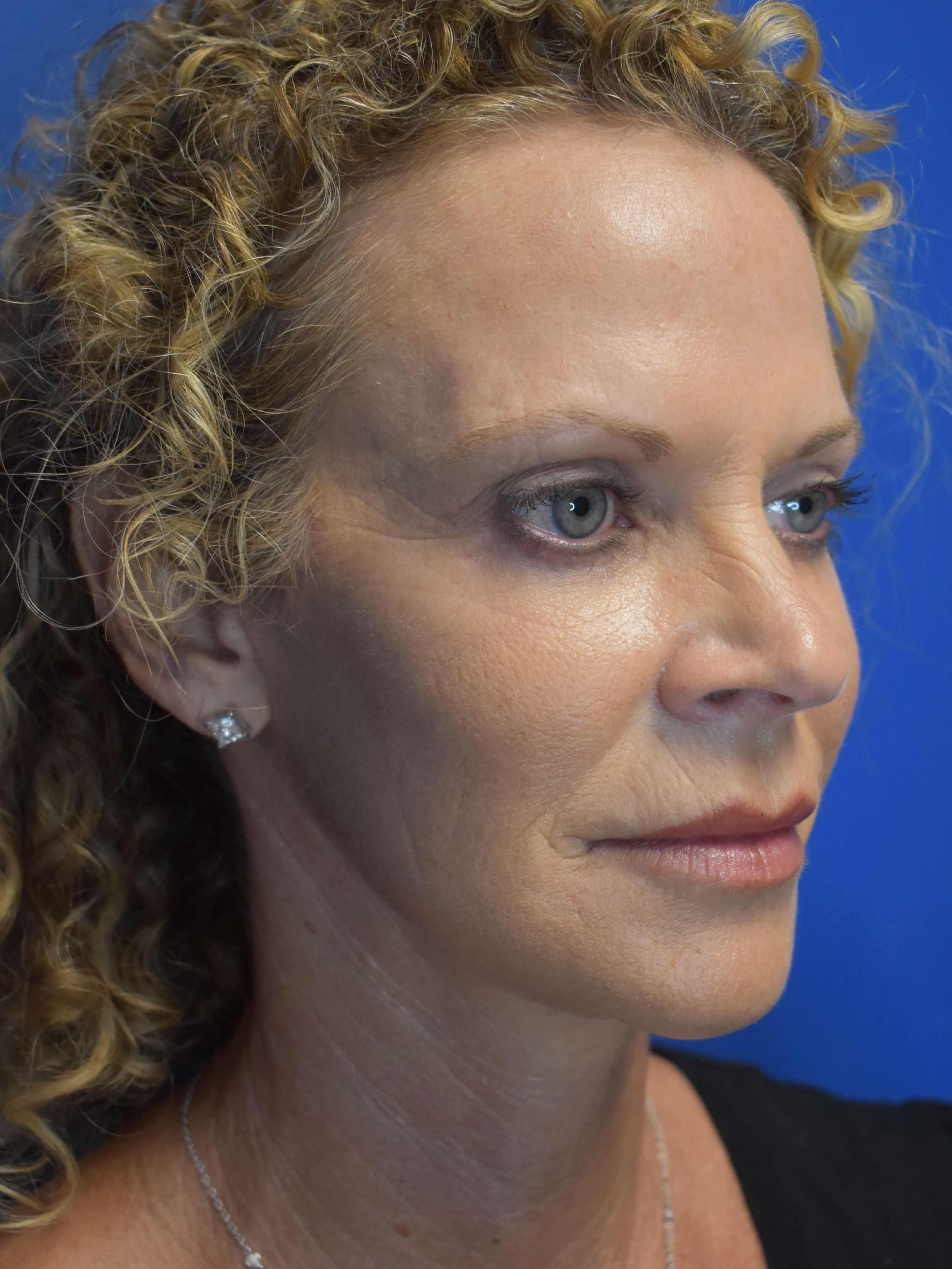 Facelift + Lower Lids After