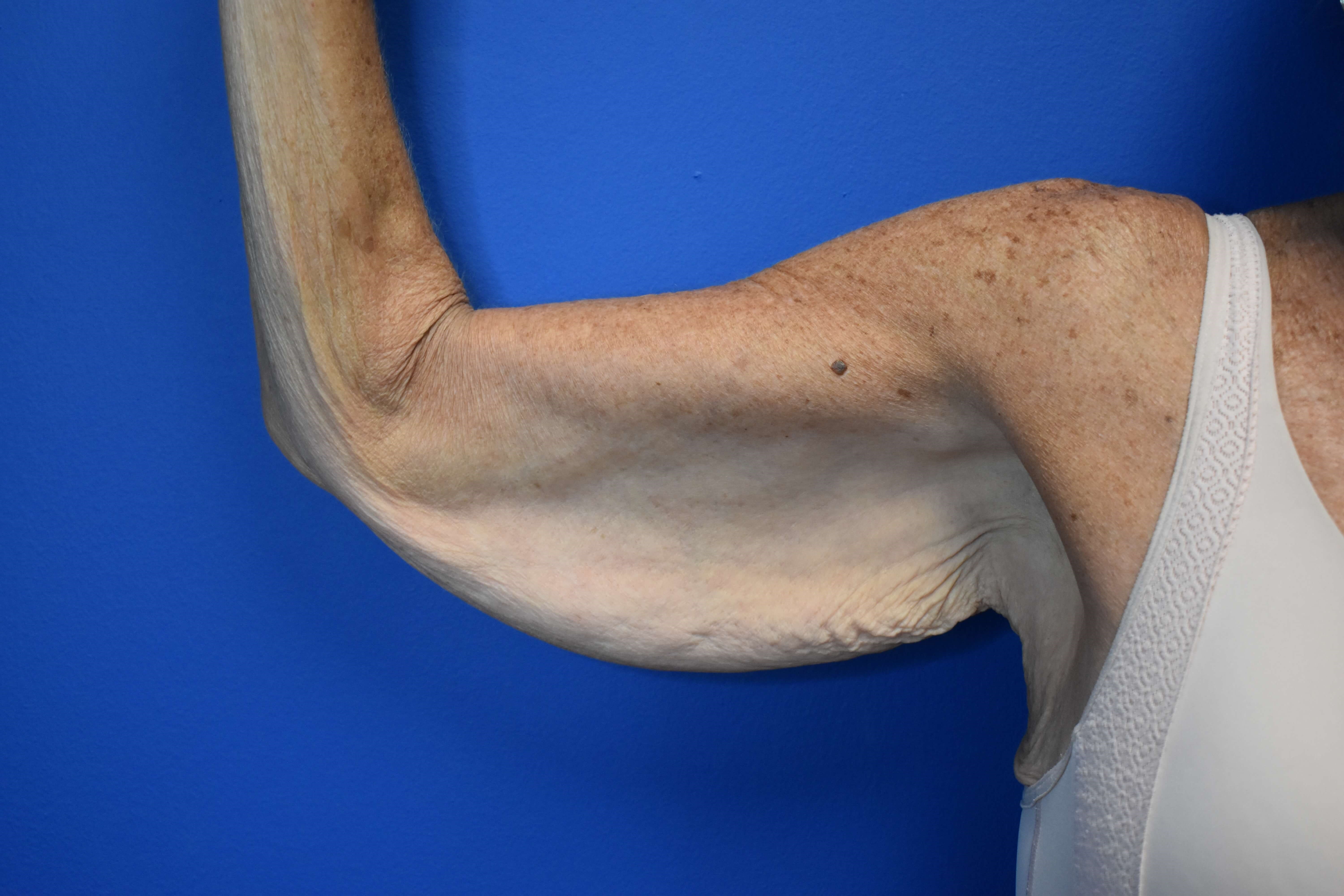 Brachioplasty Before