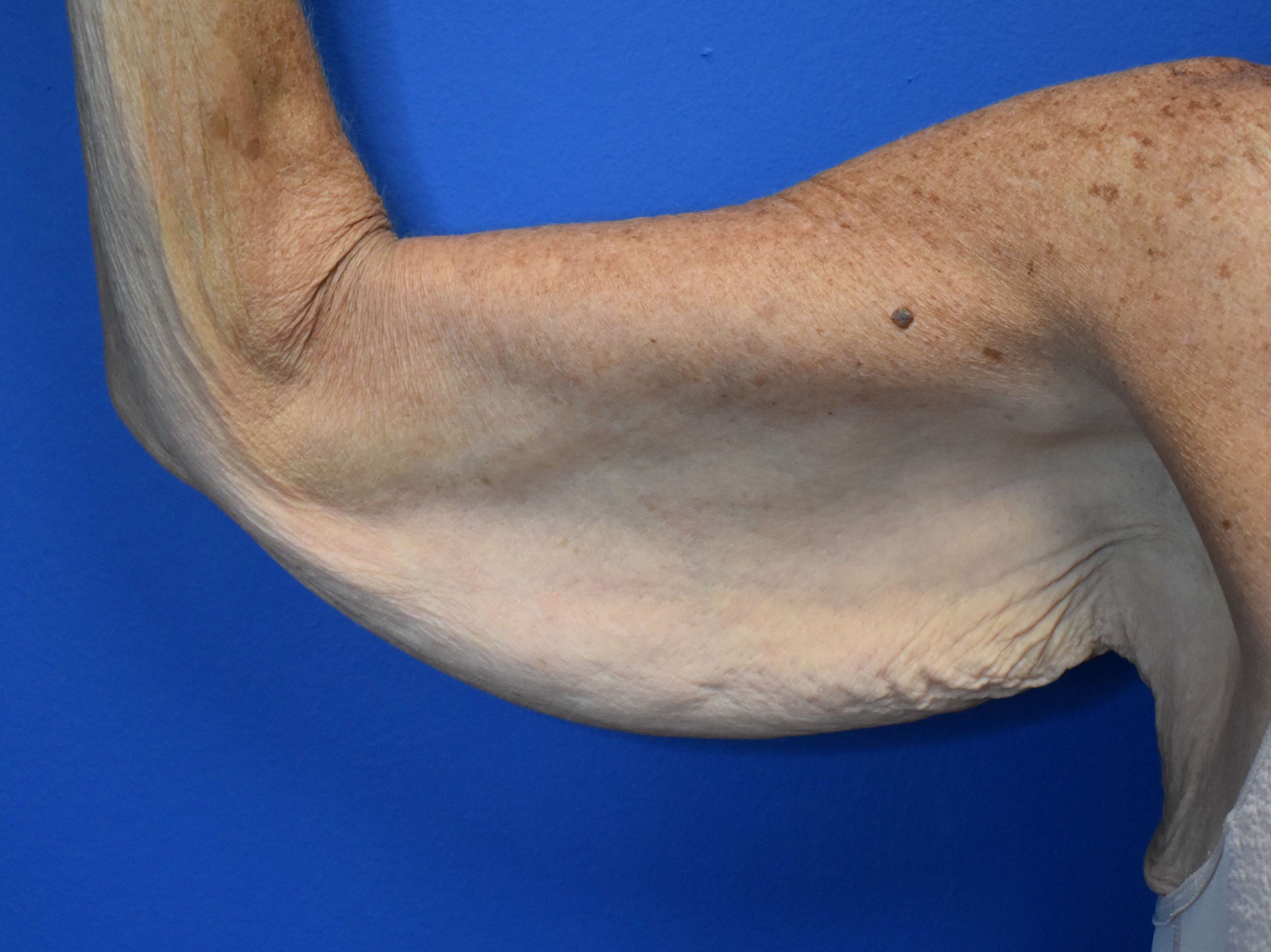 Brachioplasty Before