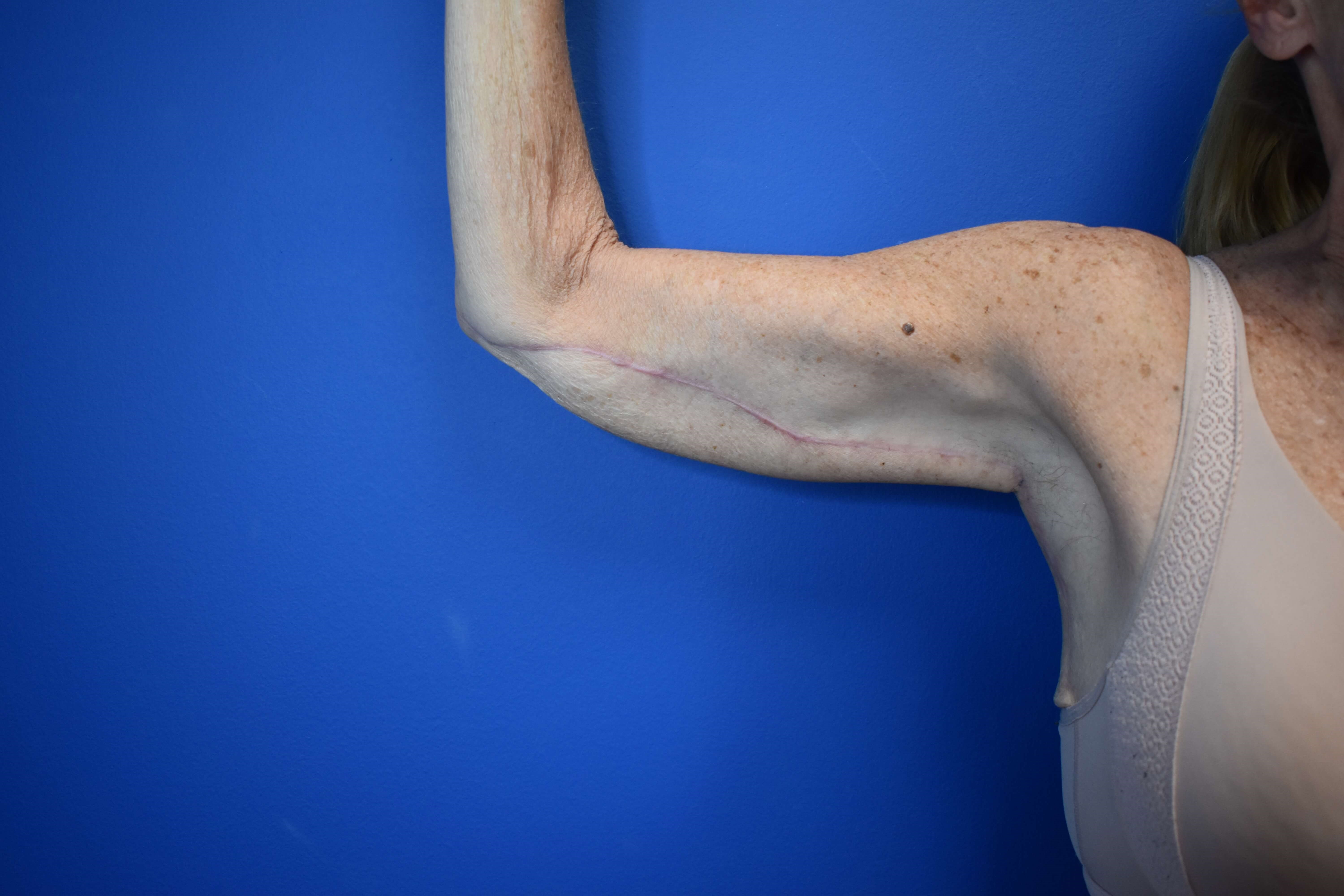 Brachioplasty After