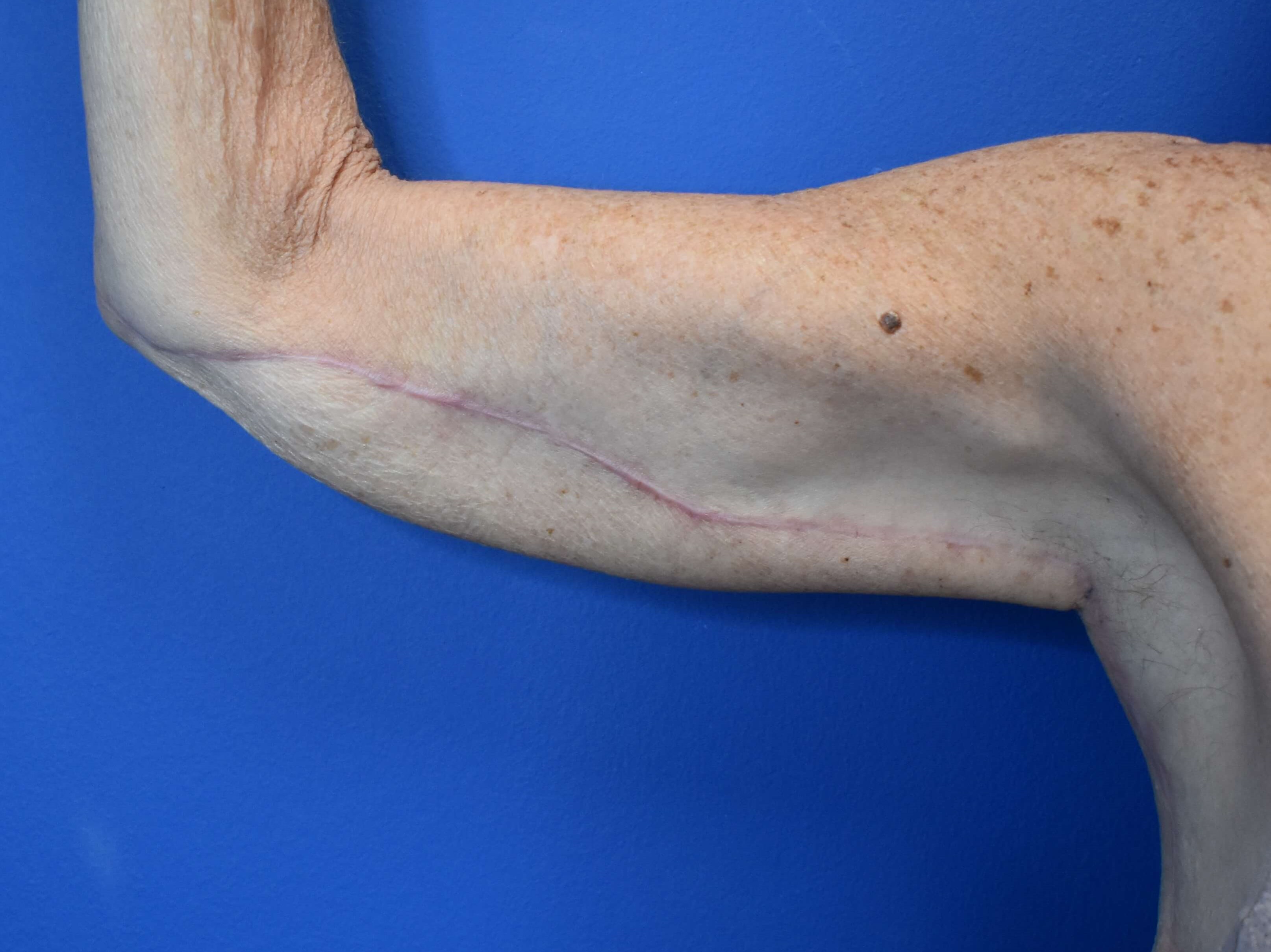 Brachioplasty After