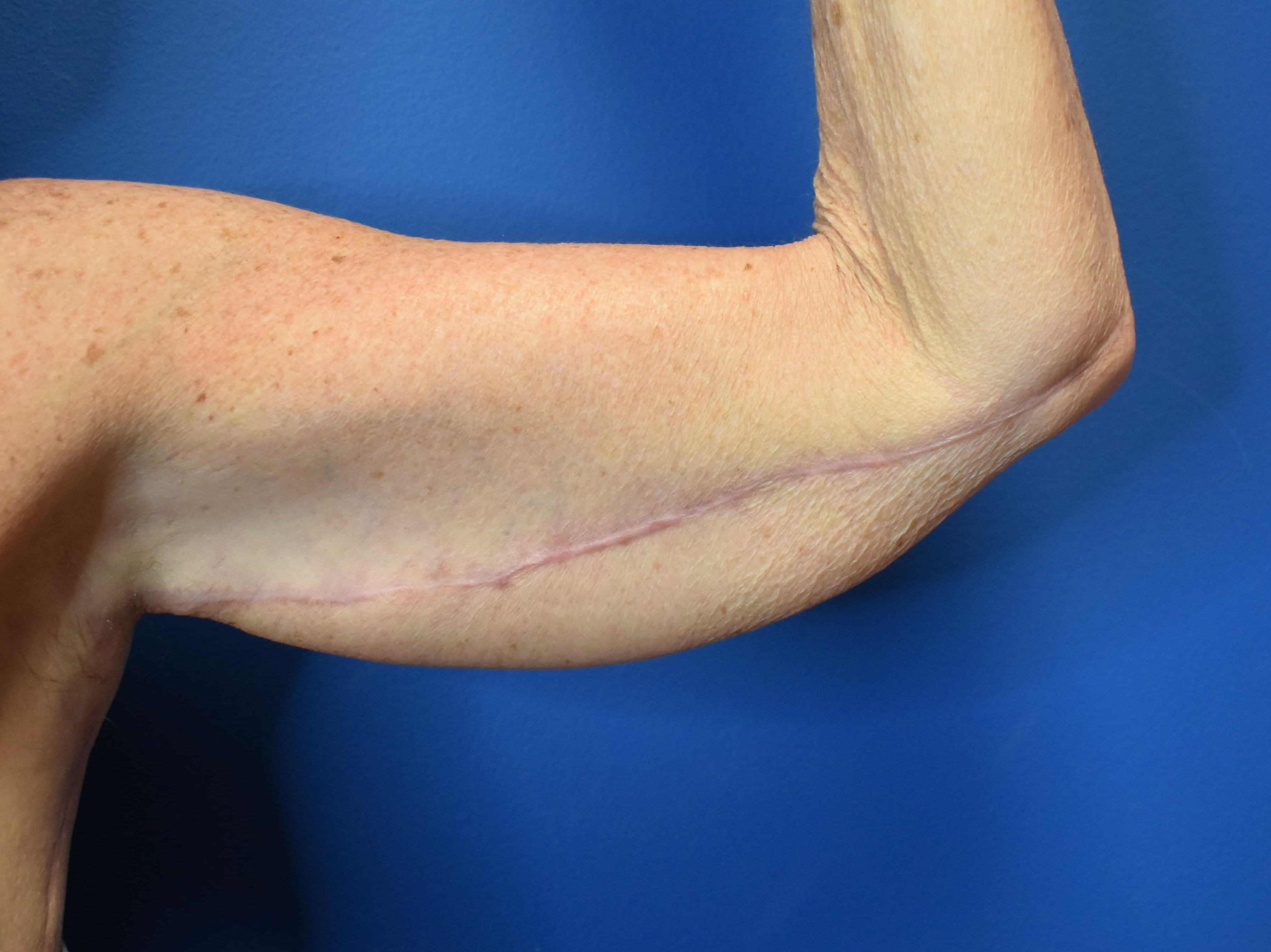 Brachioplasty After