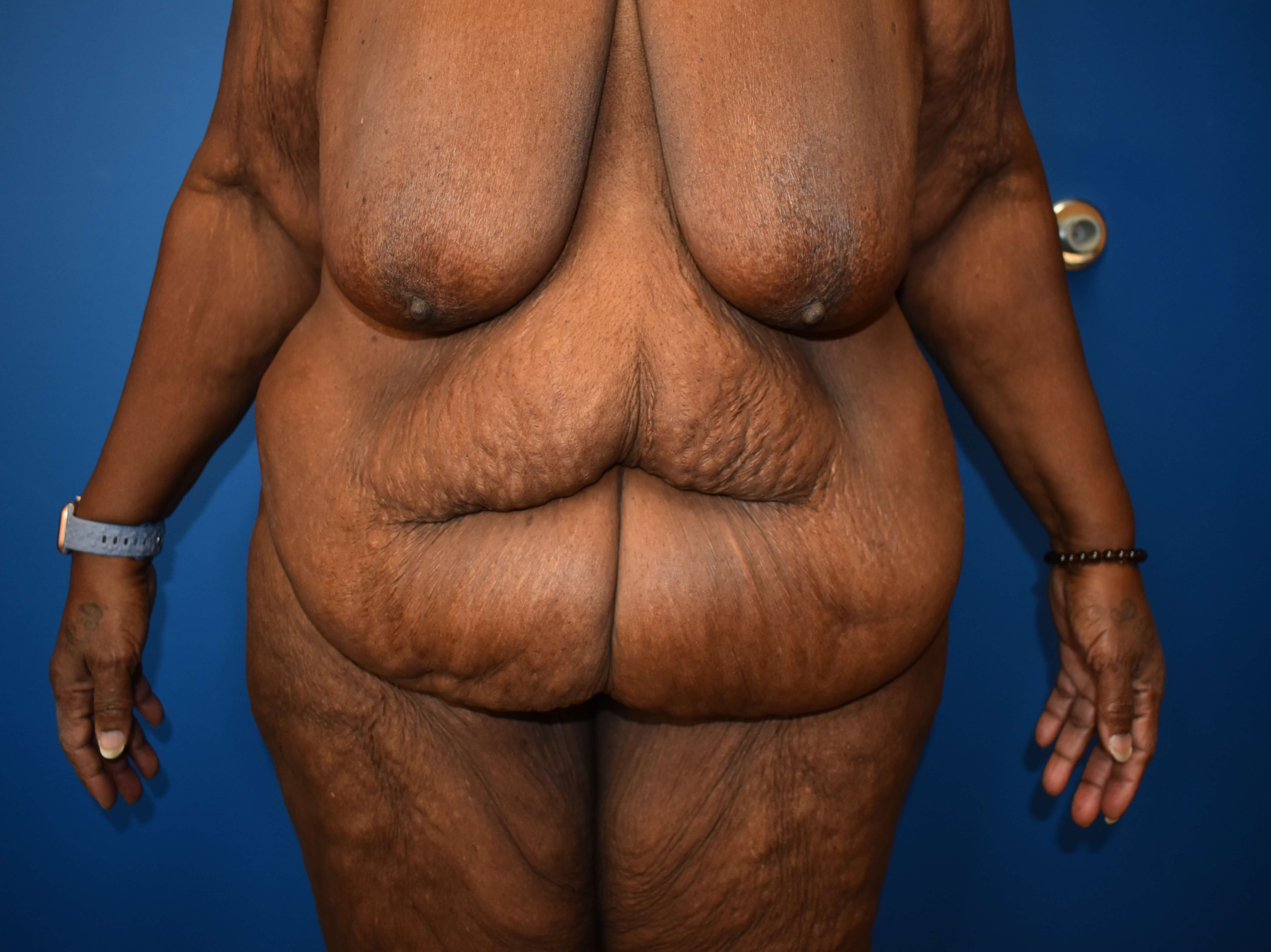 After weight loss surgery Before