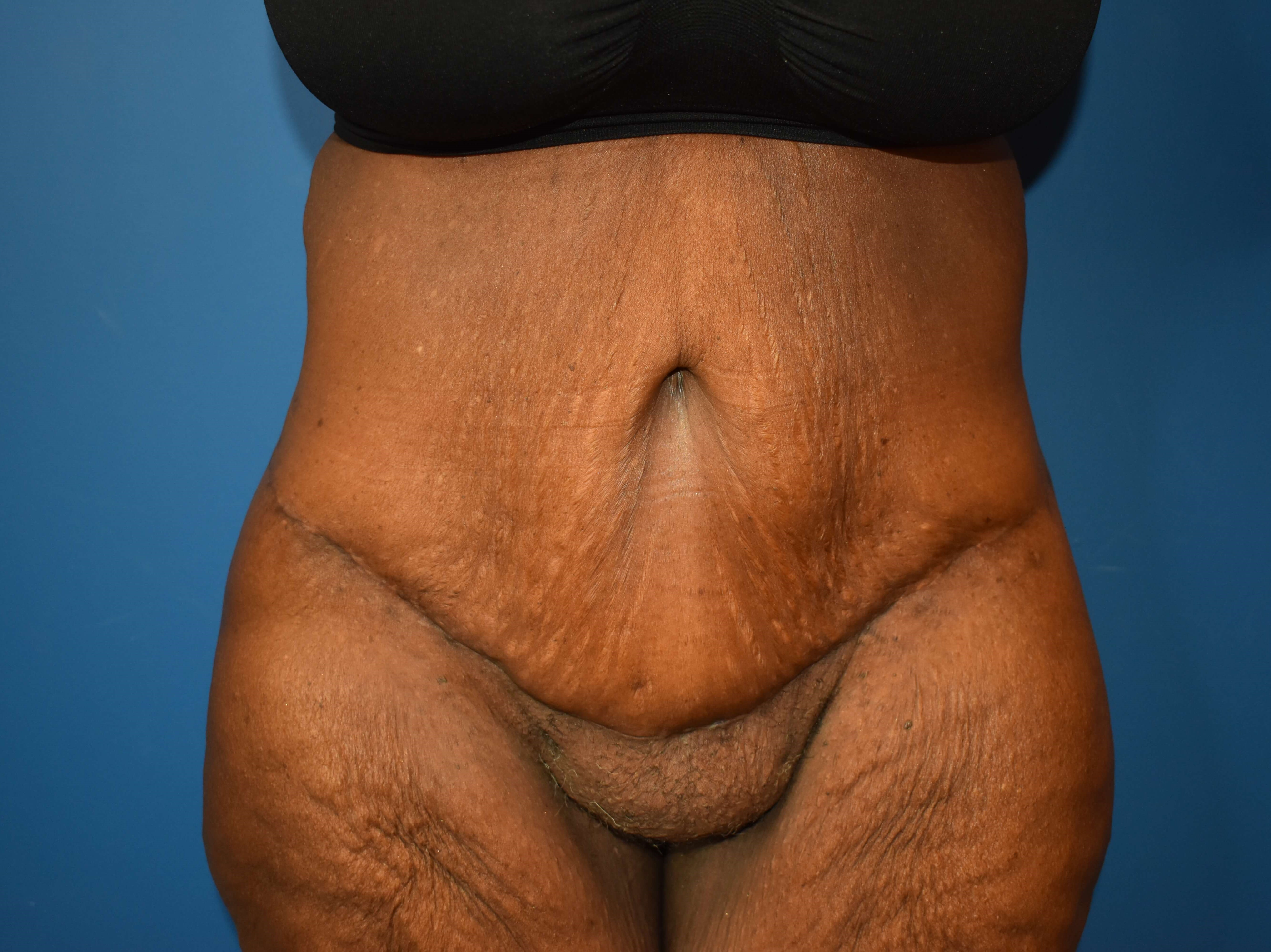 After weight loss surgery After