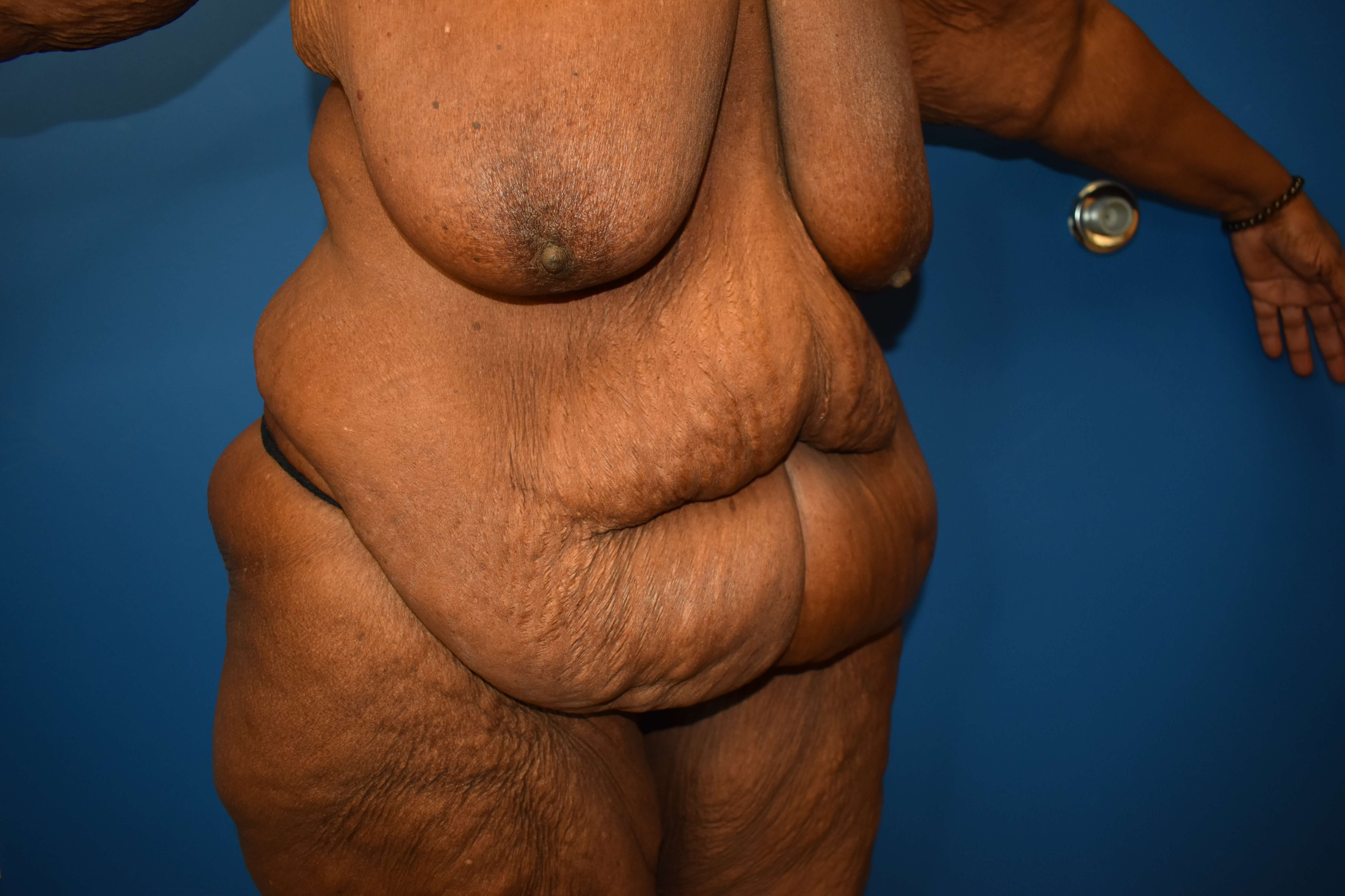 After weight loss surgery Before