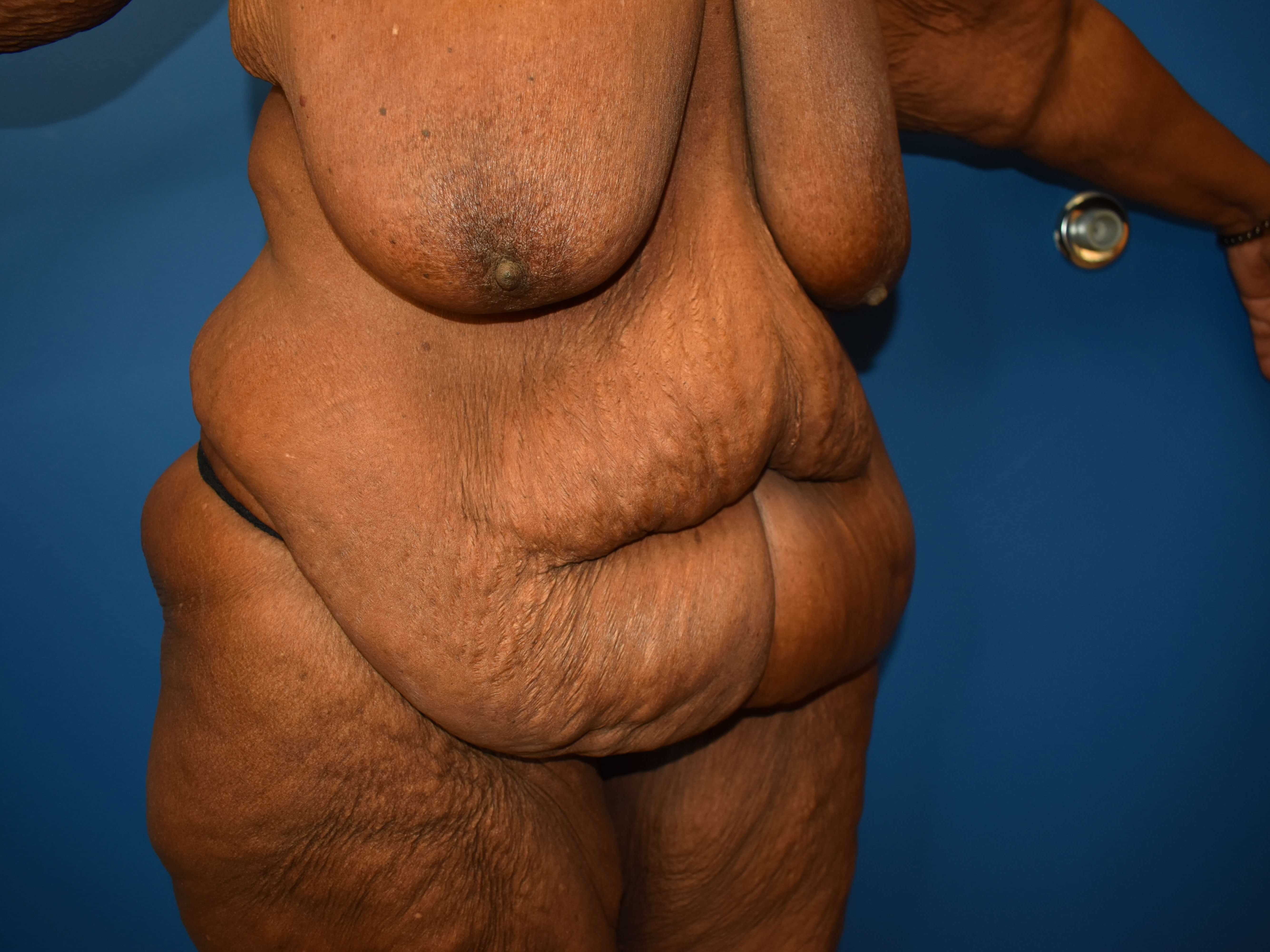 After weight loss surgery Before