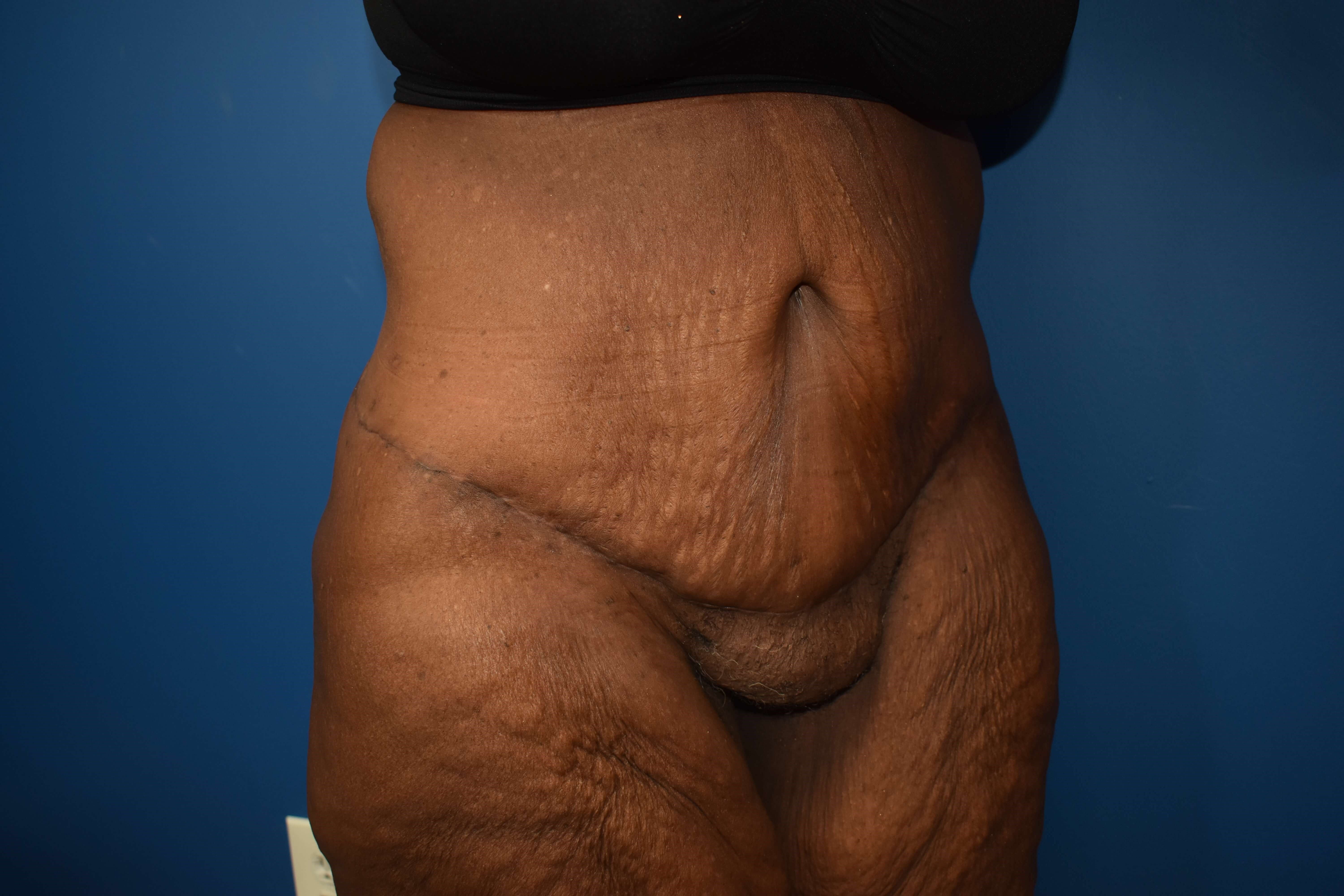 After weight loss surgery After