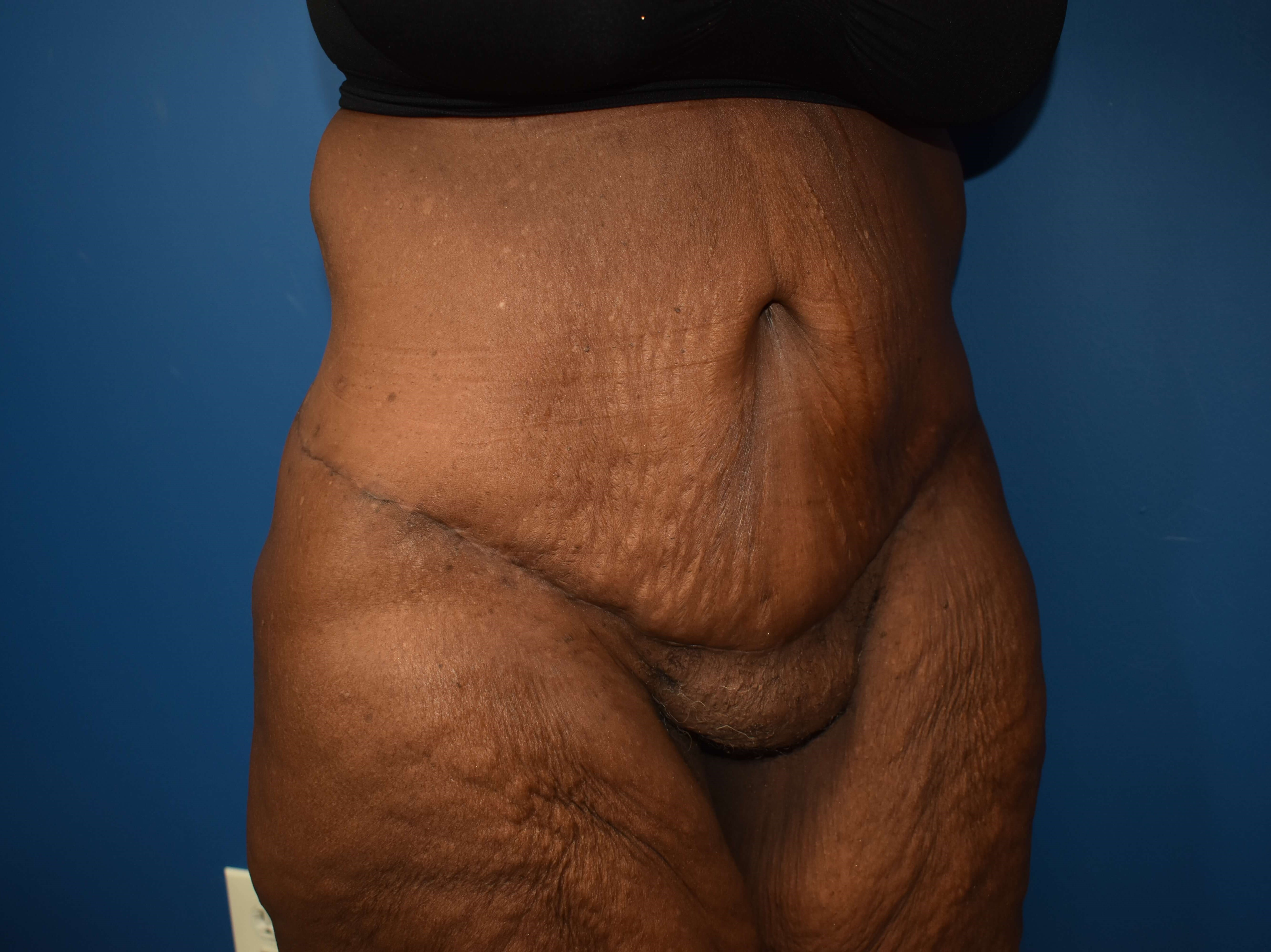 After weight loss surgery After