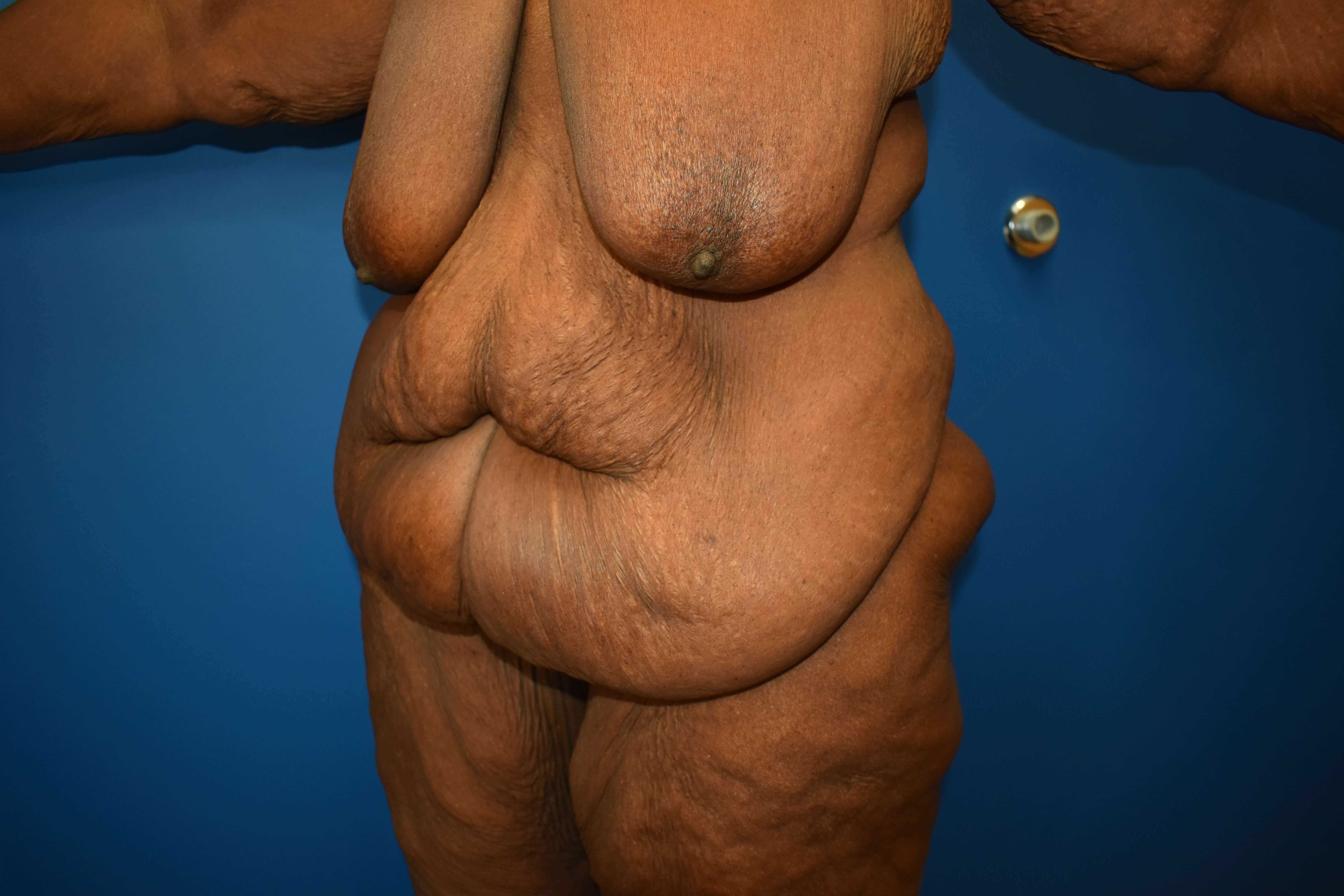 After weight loss surgery Before