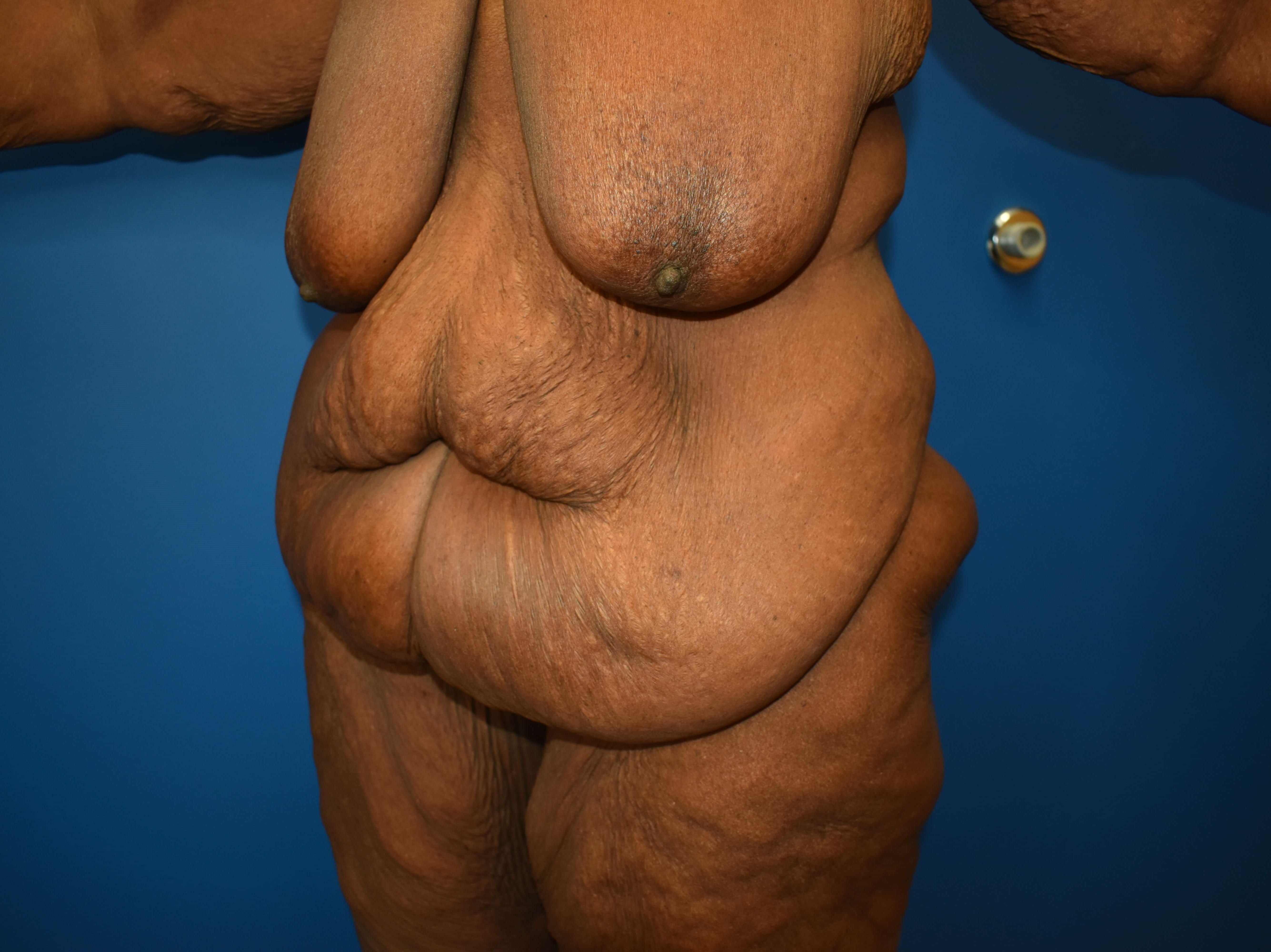 After weight loss surgery Before