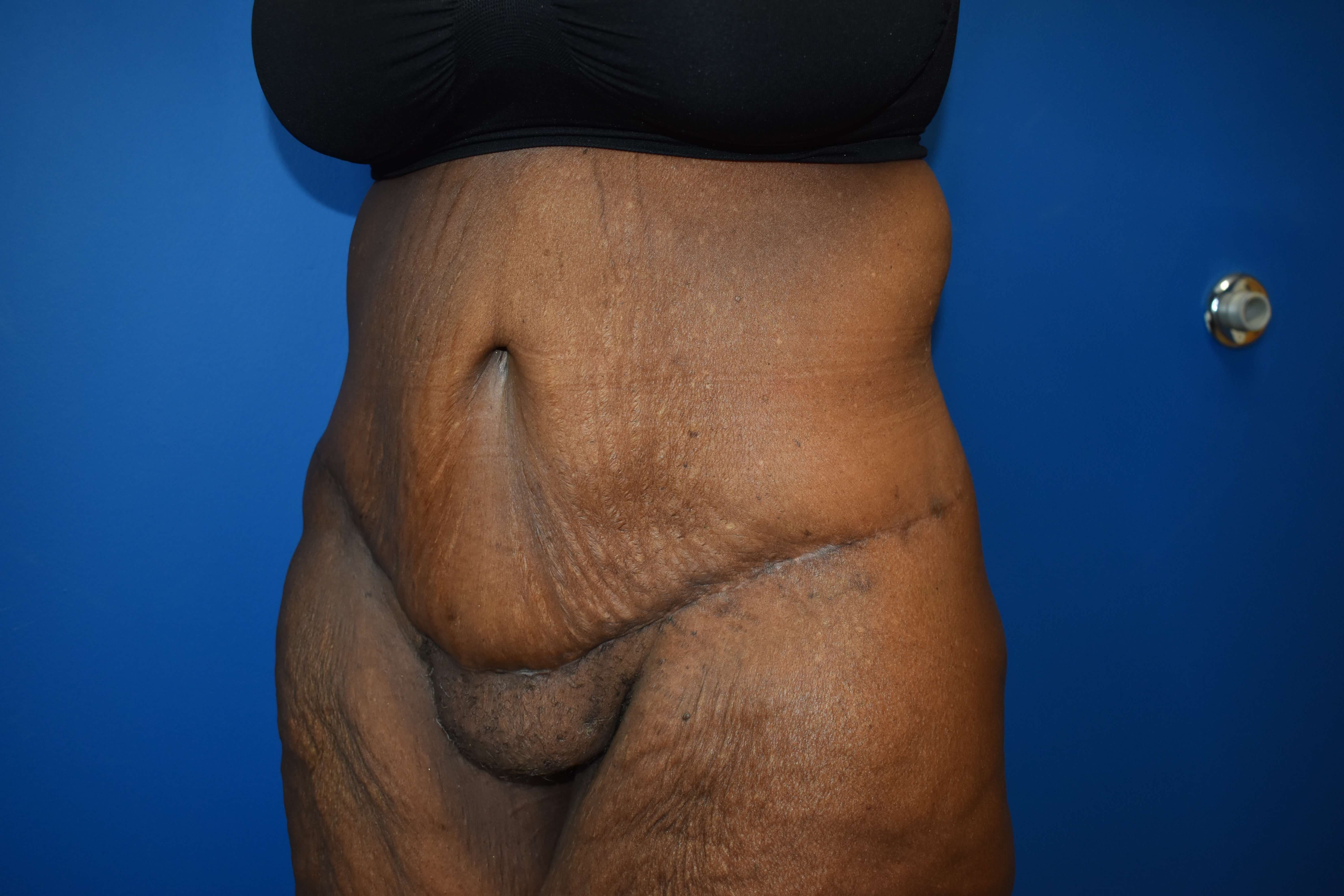 After weight loss surgery After