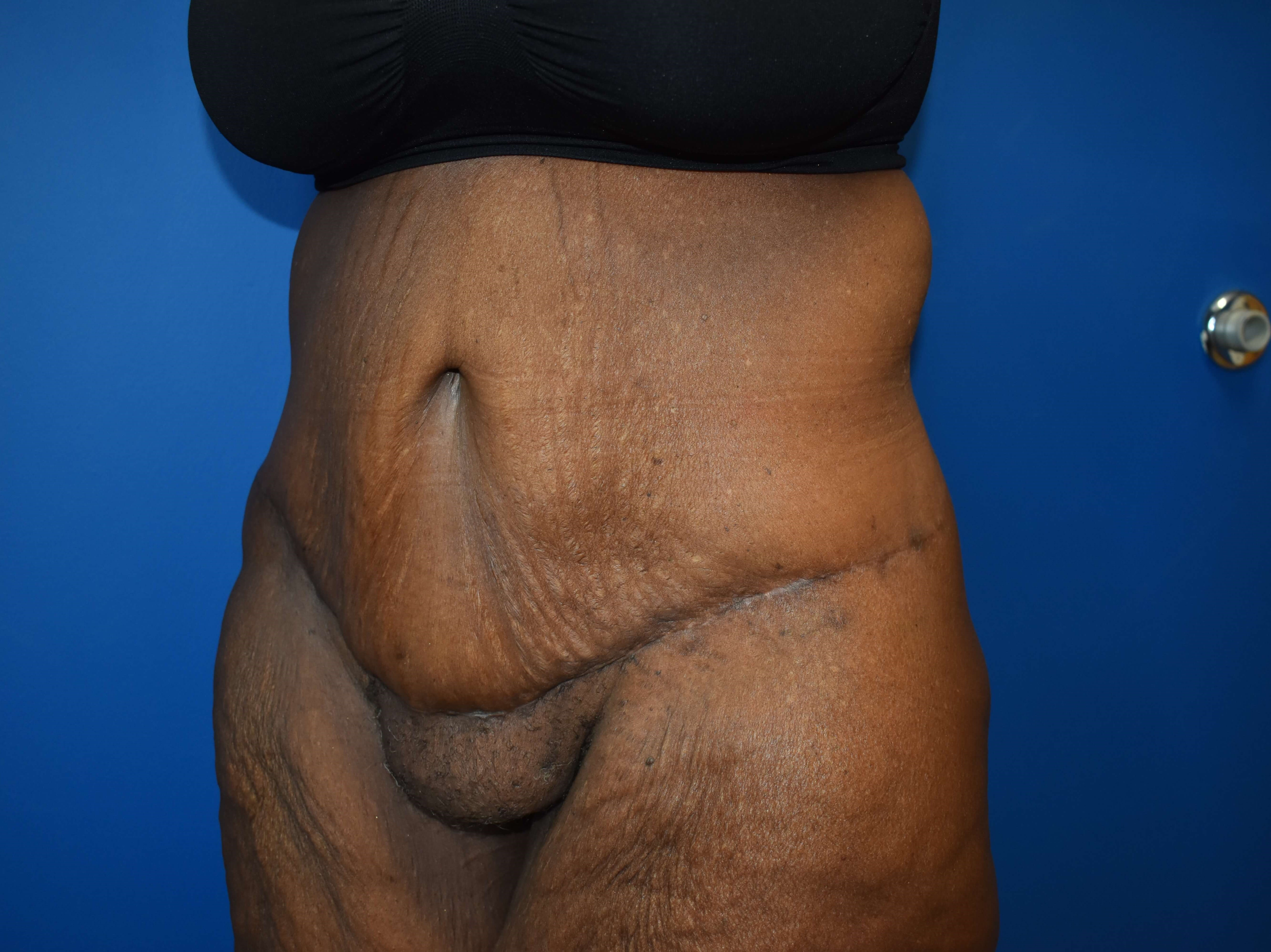 After weight loss surgery After