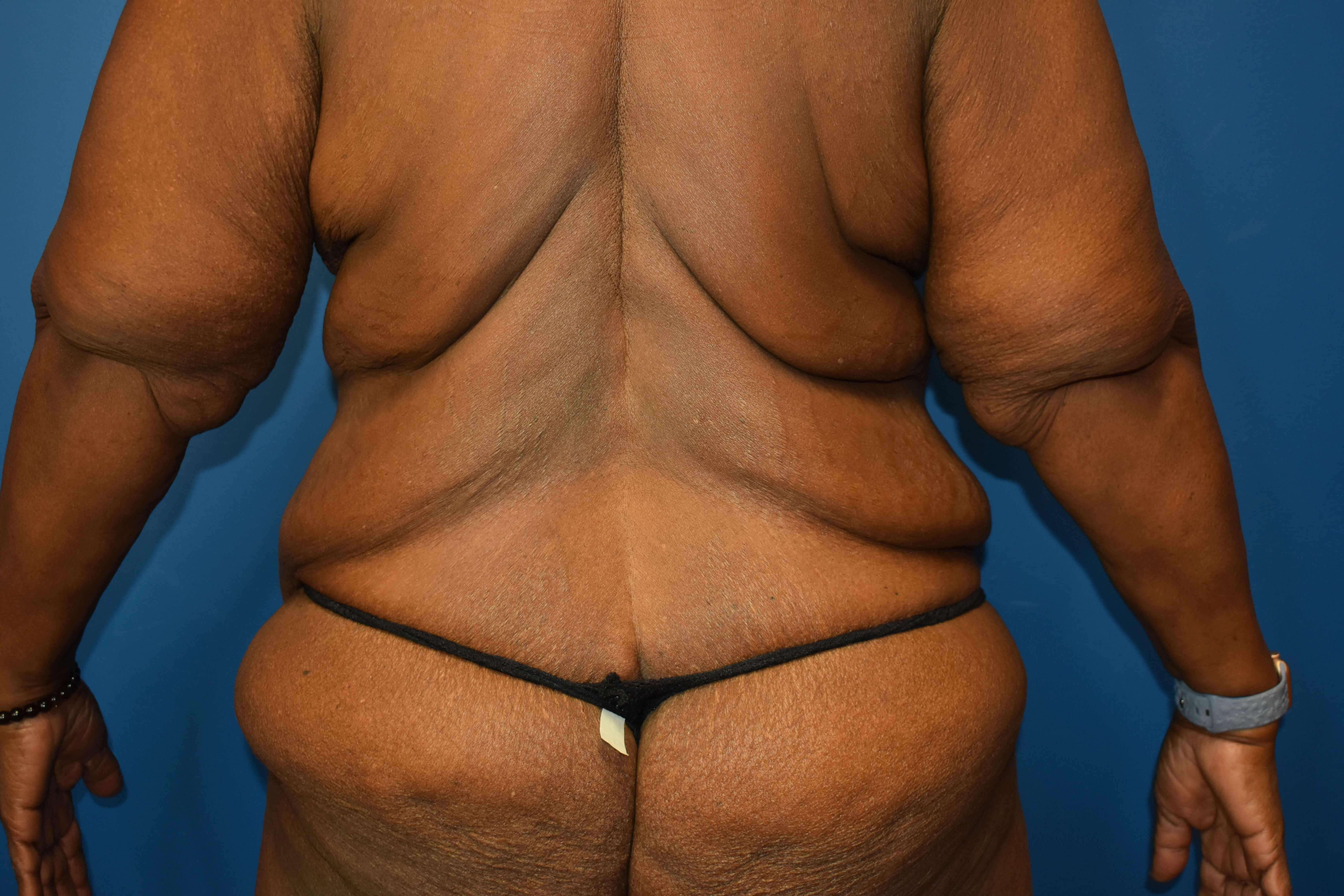 After weight loss surgery Before