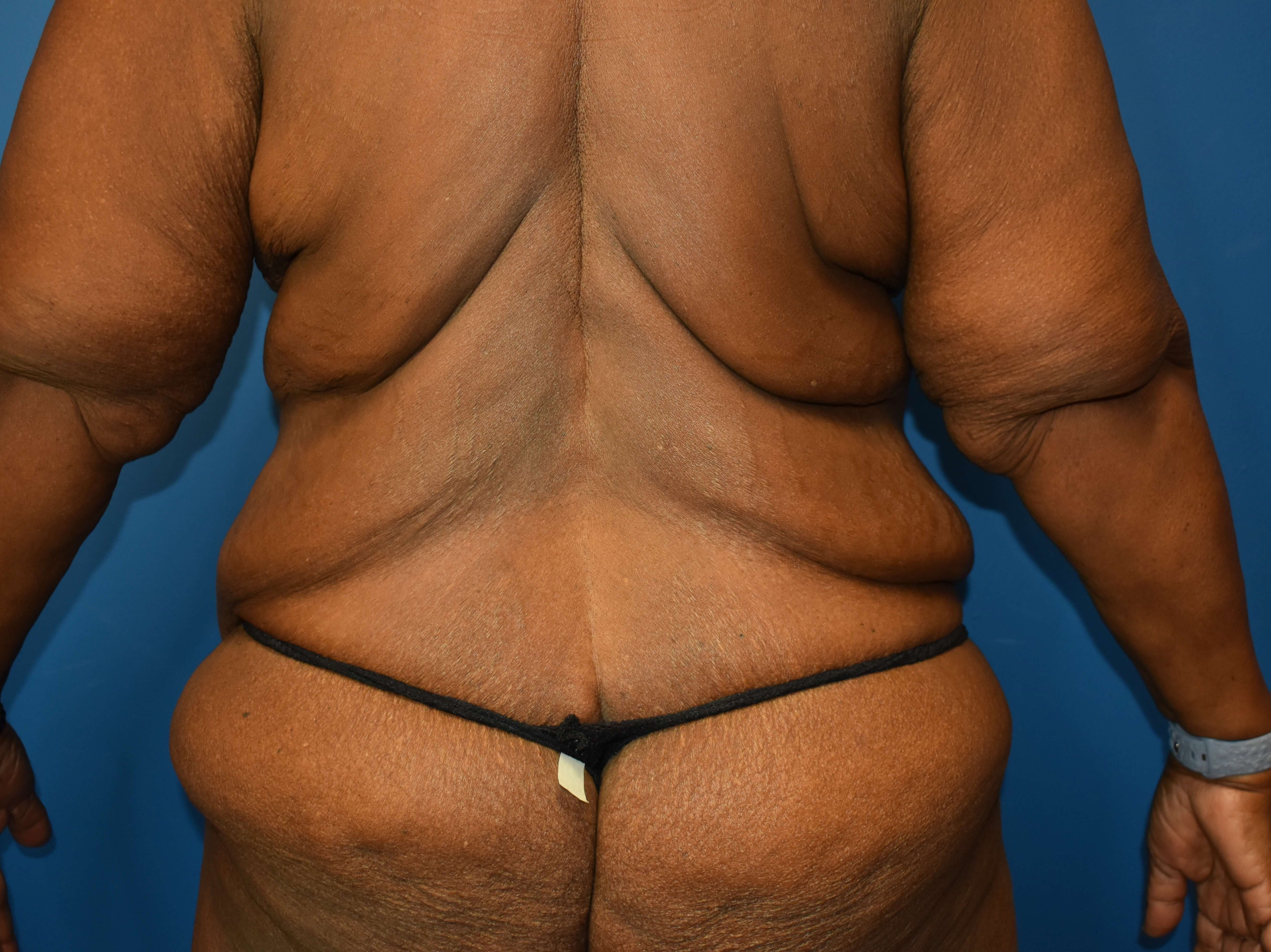 After weight loss surgery Before
