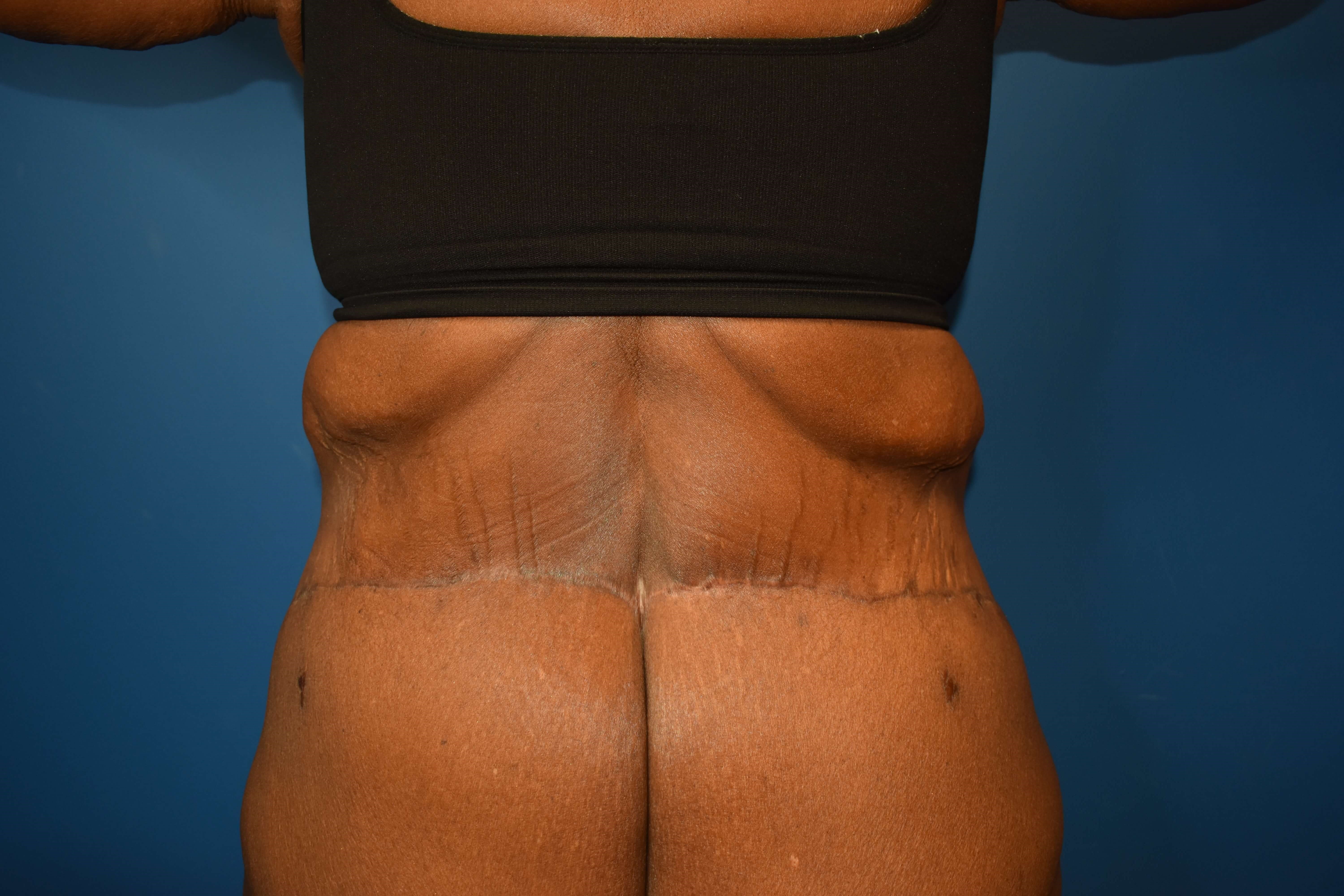 After weight loss surgery After