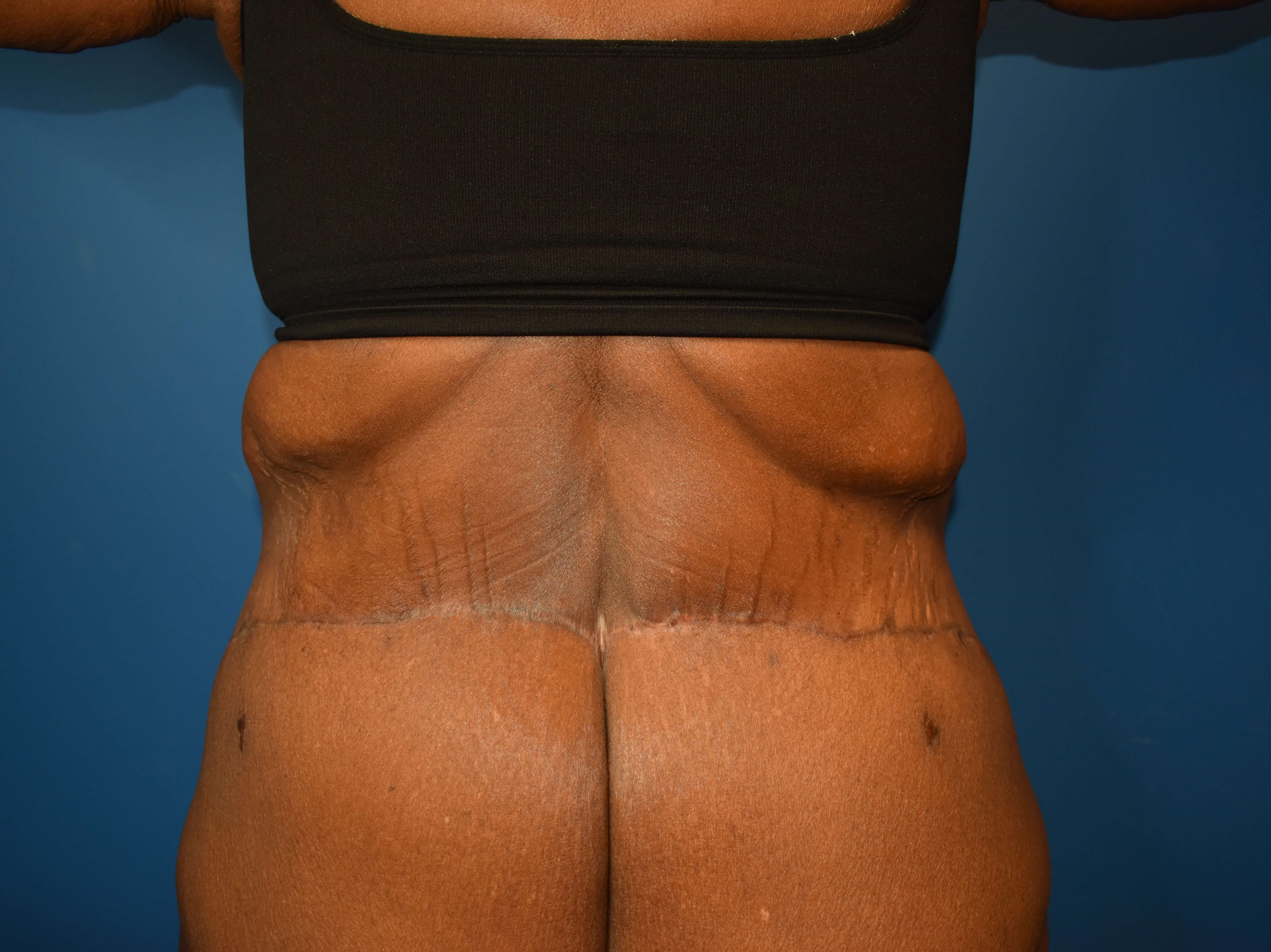 After weight loss surgery After