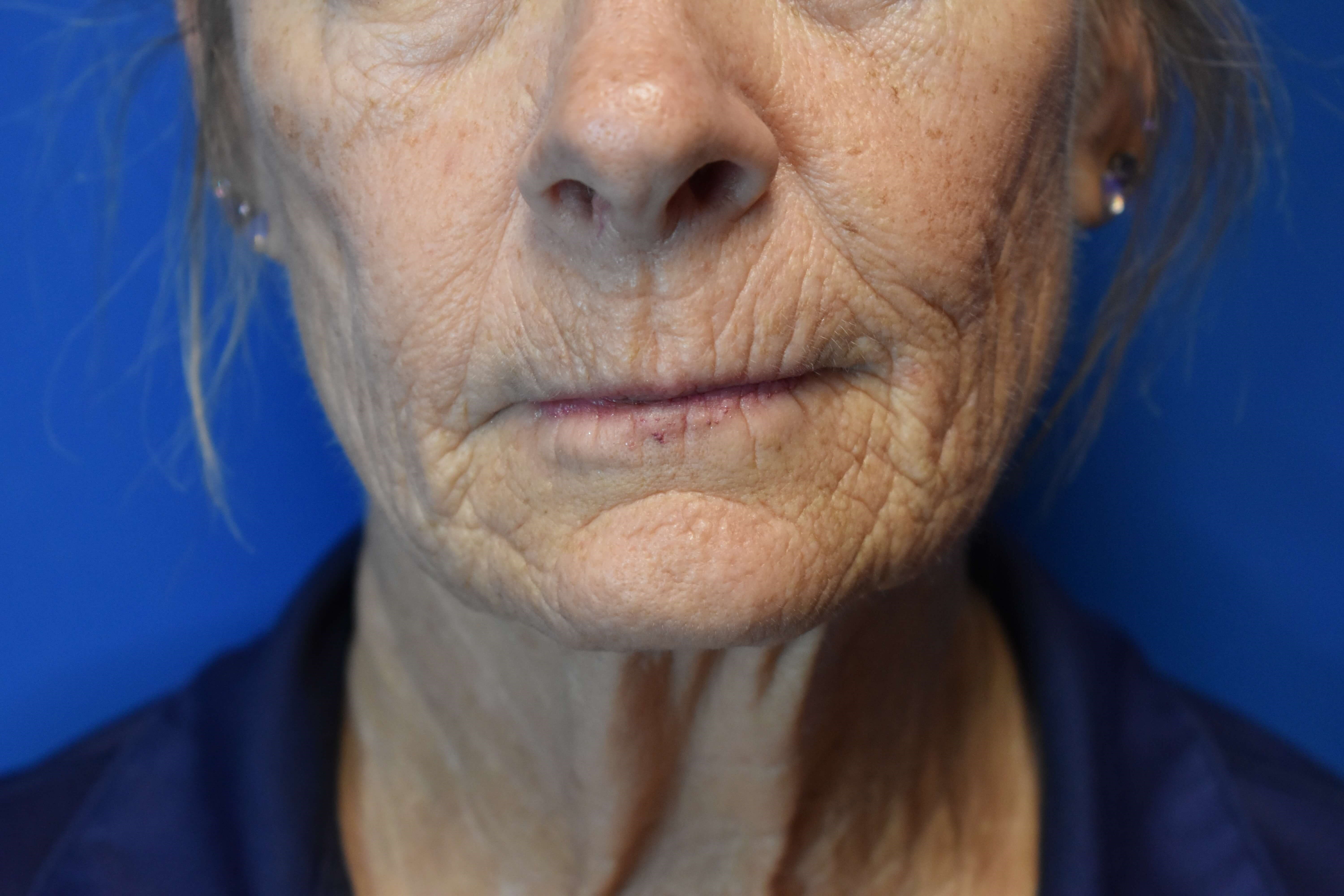 Fully Ablative Laser Before
