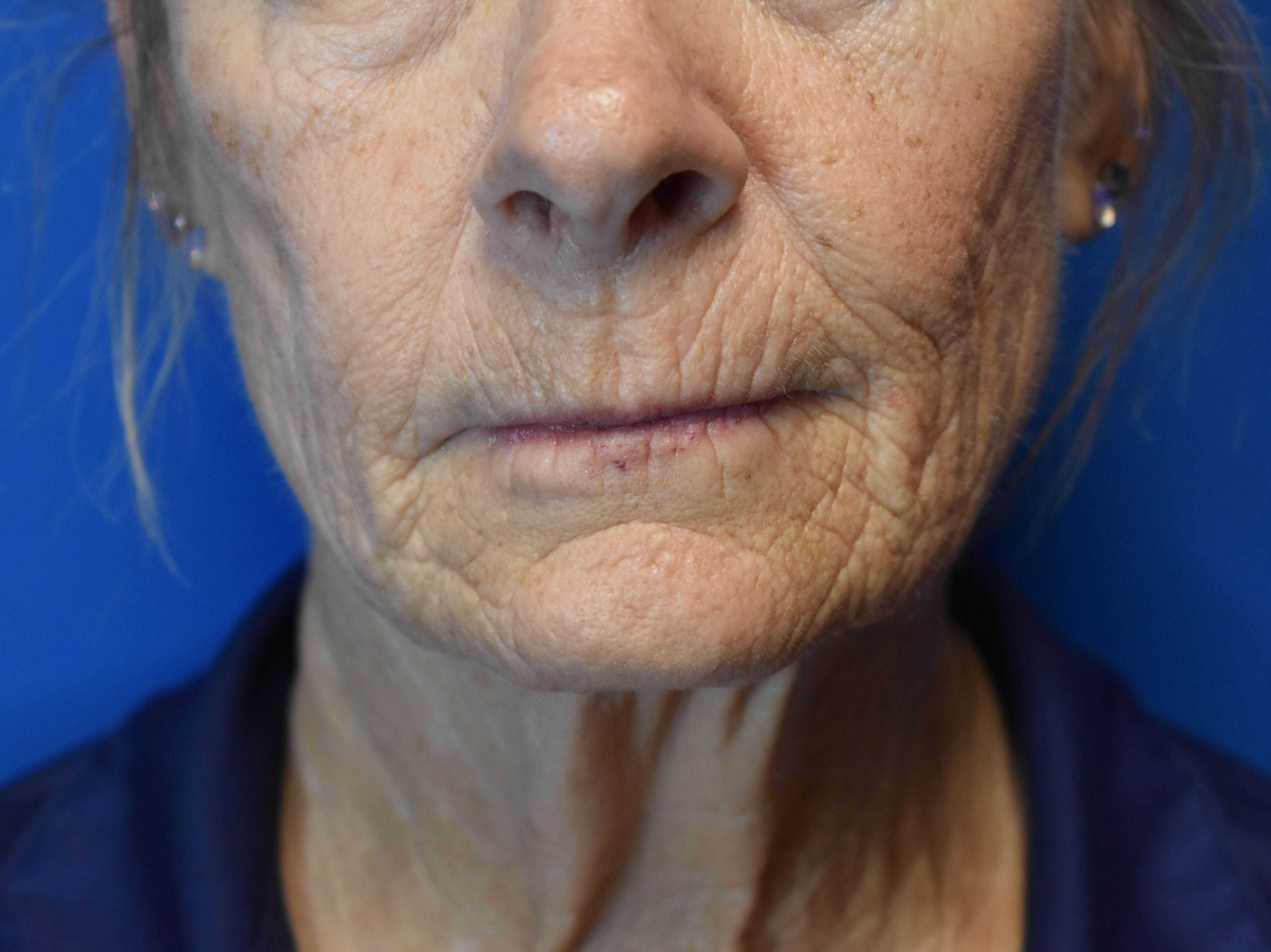 Fully Ablative Laser Before