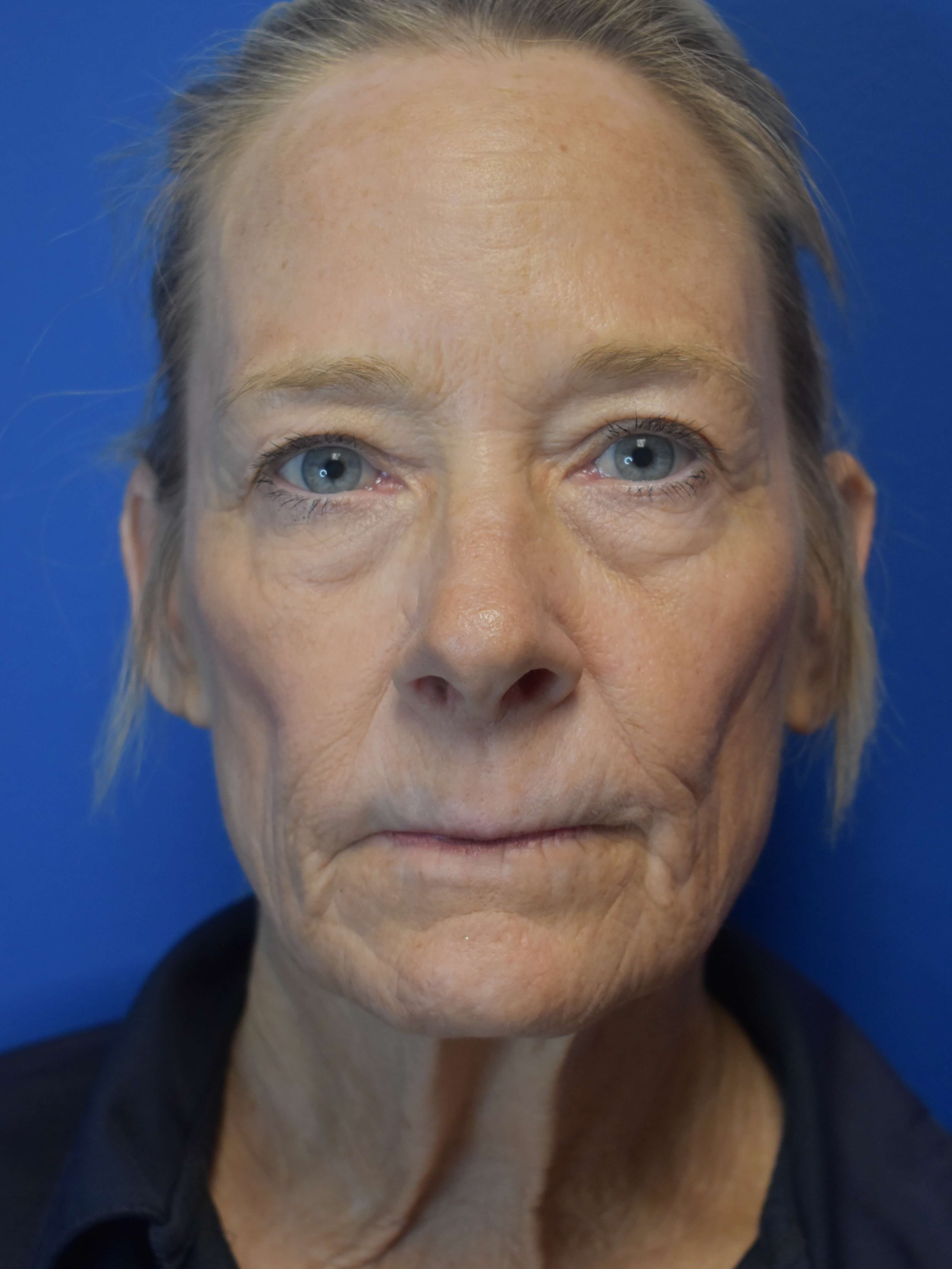 Fully Ablative Laser After