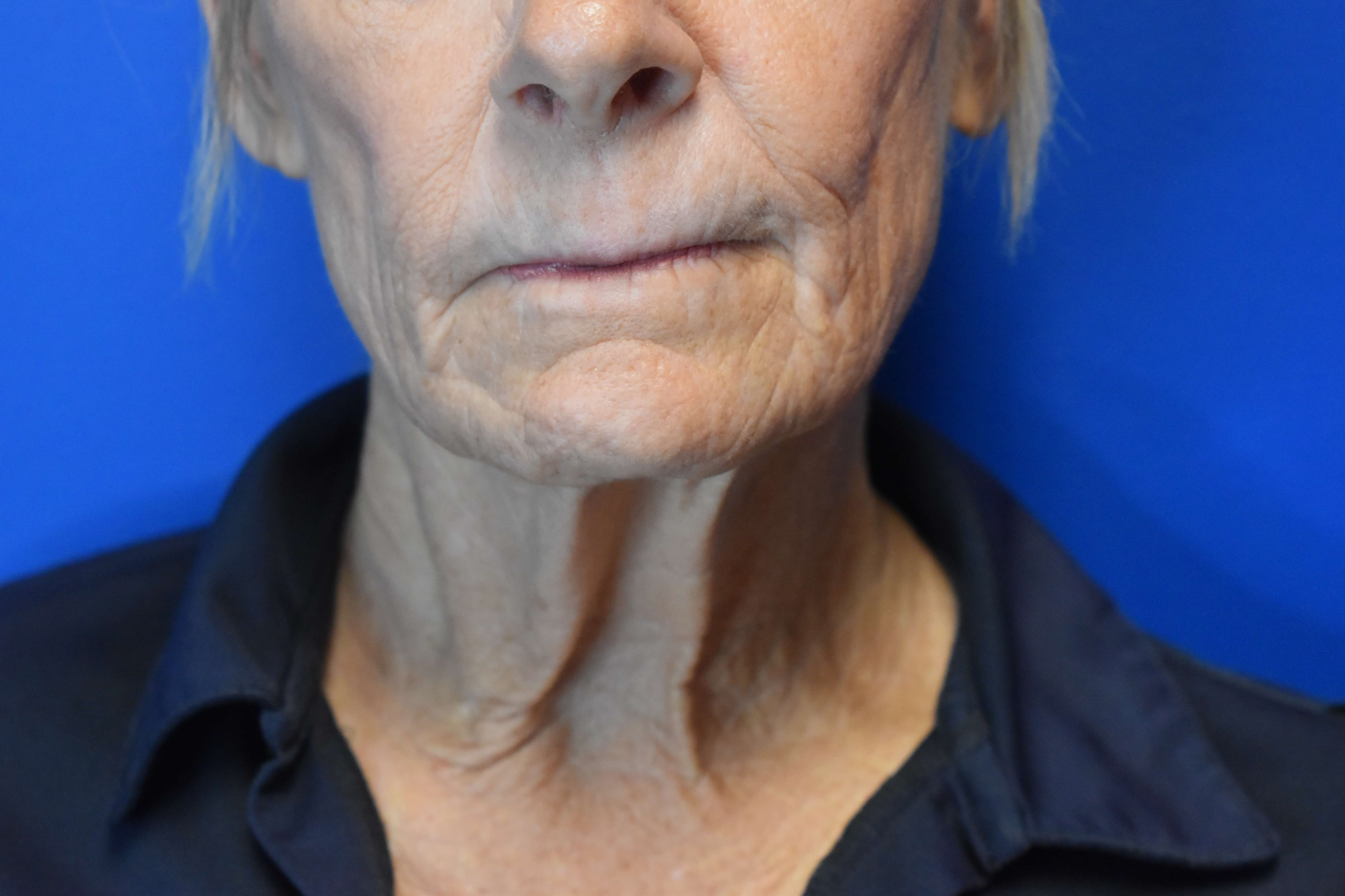 Fully Ablative Laser After