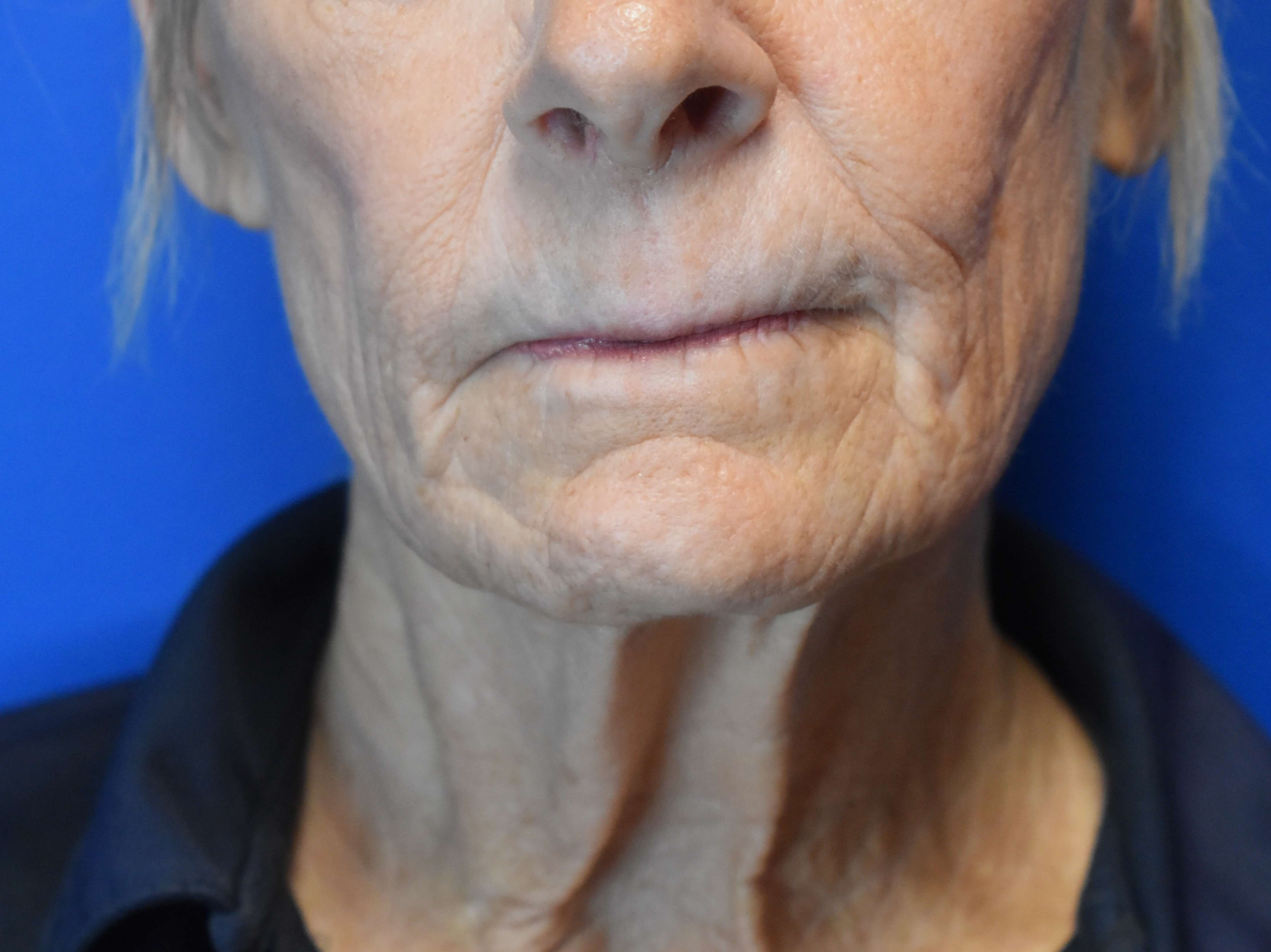 Fully Ablative Laser After