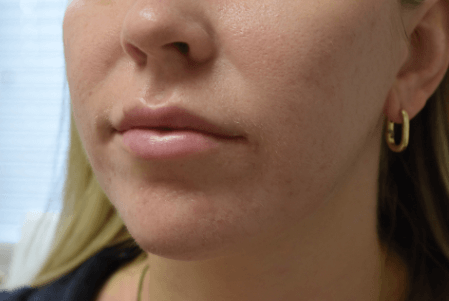 Lip Enhancement Before