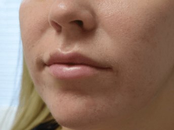 Lip Enhancement Before