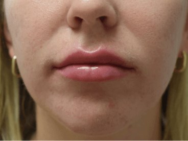 Lip Enhancement After