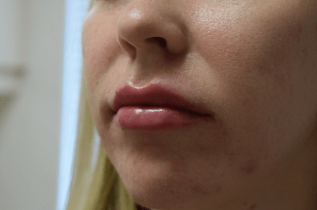 Lip Enhancement After