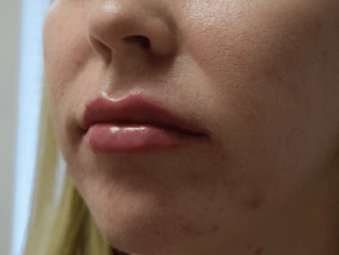 Lip Enhancement After