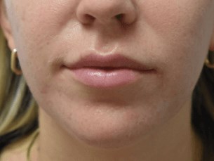 Lip Enhancement Before