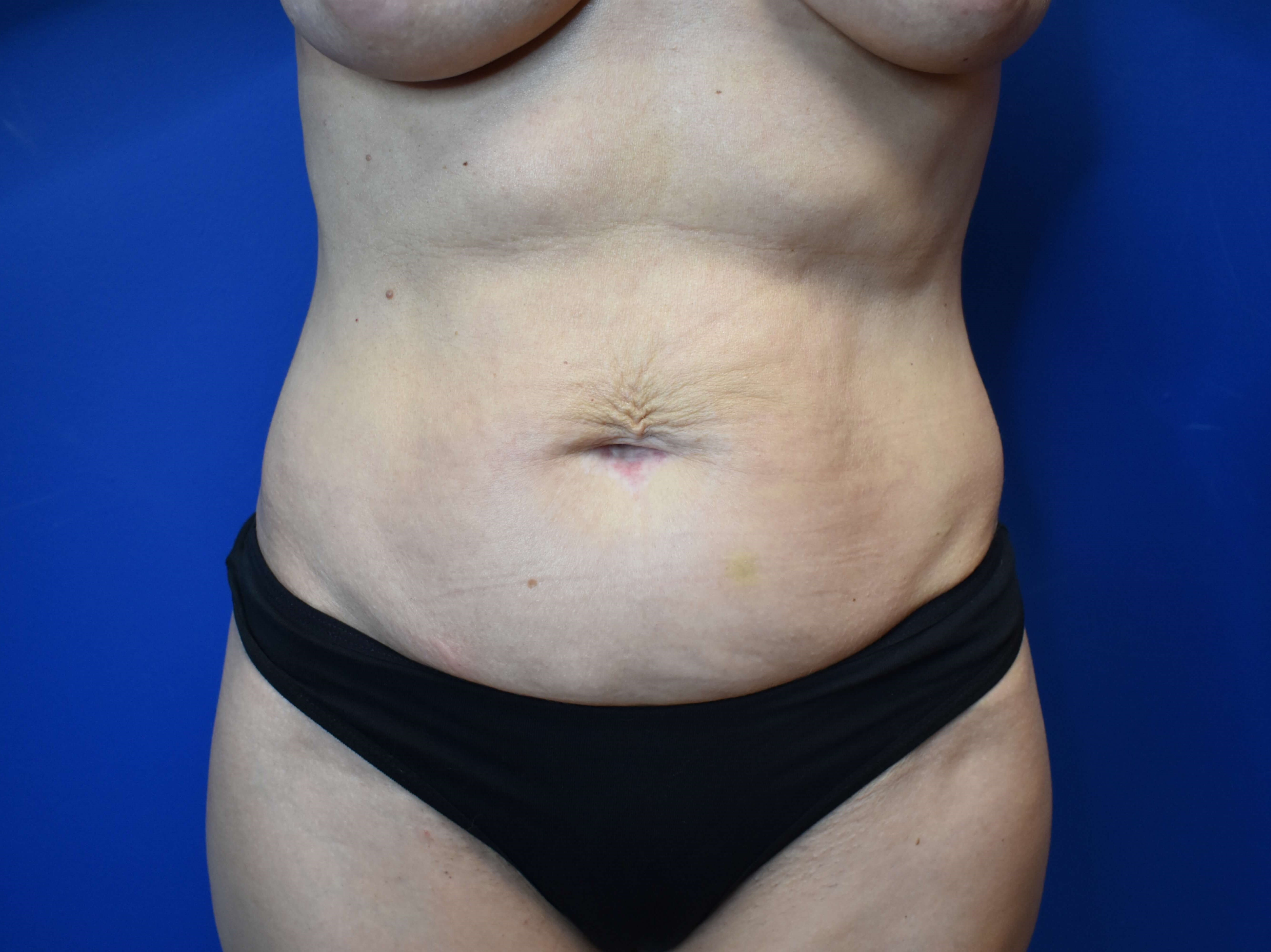Abdominoplasty Before